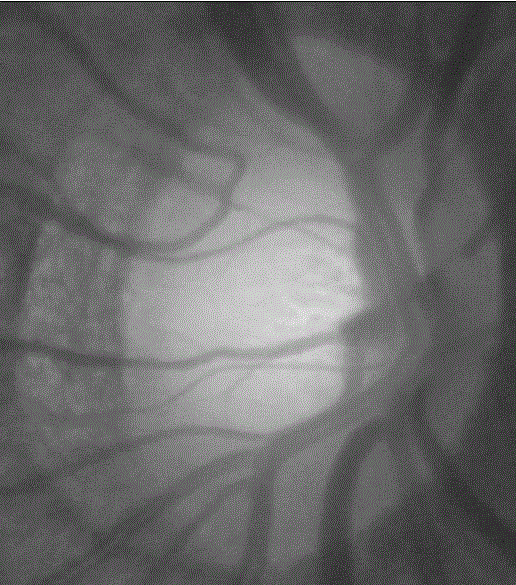 Glaucoma early stage screening method