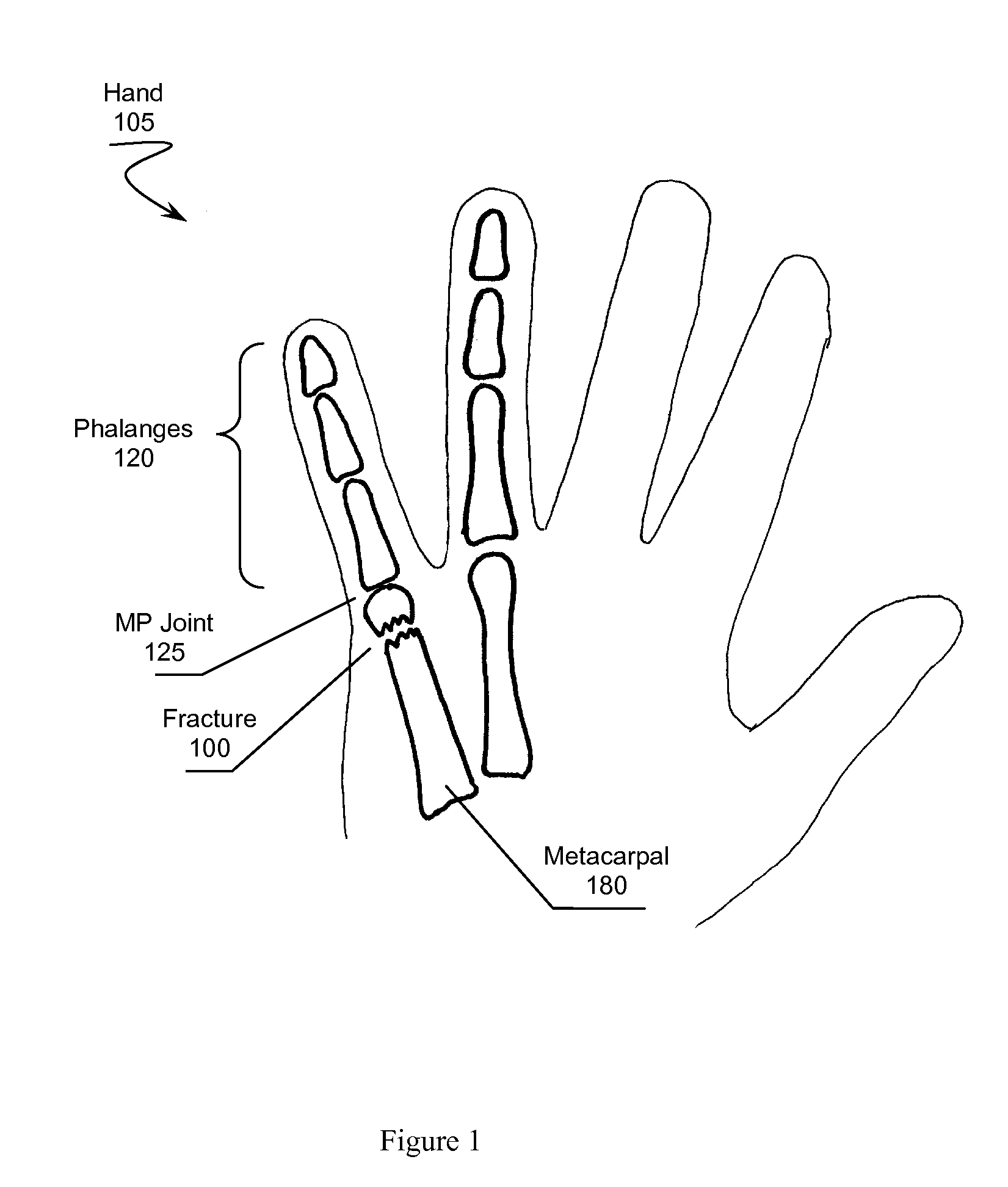 Brace for Reducing a Metacarpal Fracture