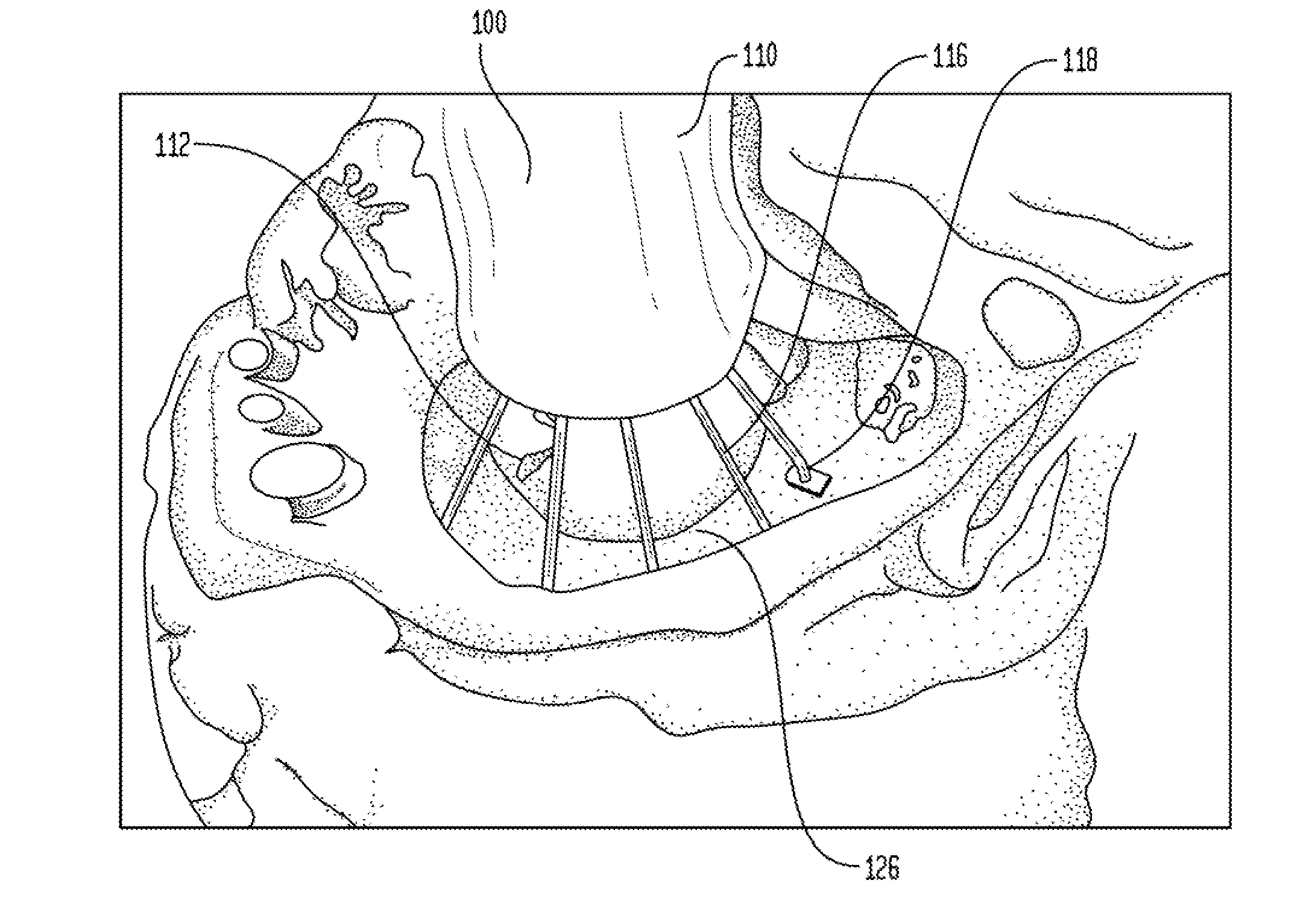 Inflatable minimally invasive system for delivering and securing an annular implant