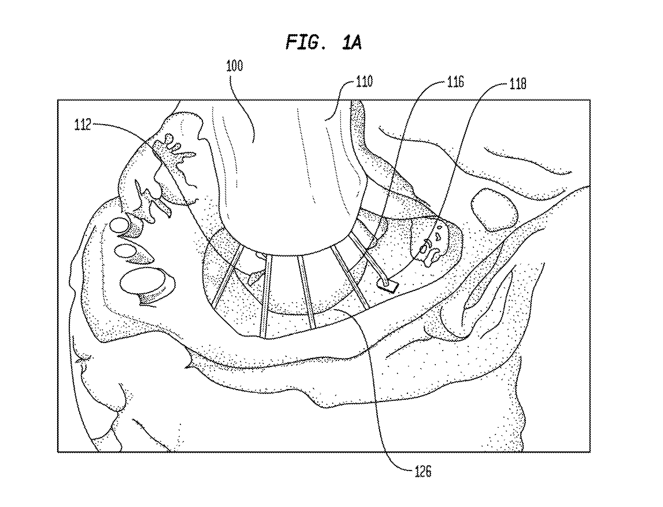 Inflatable minimally invasive system for delivering and securing an annular implant