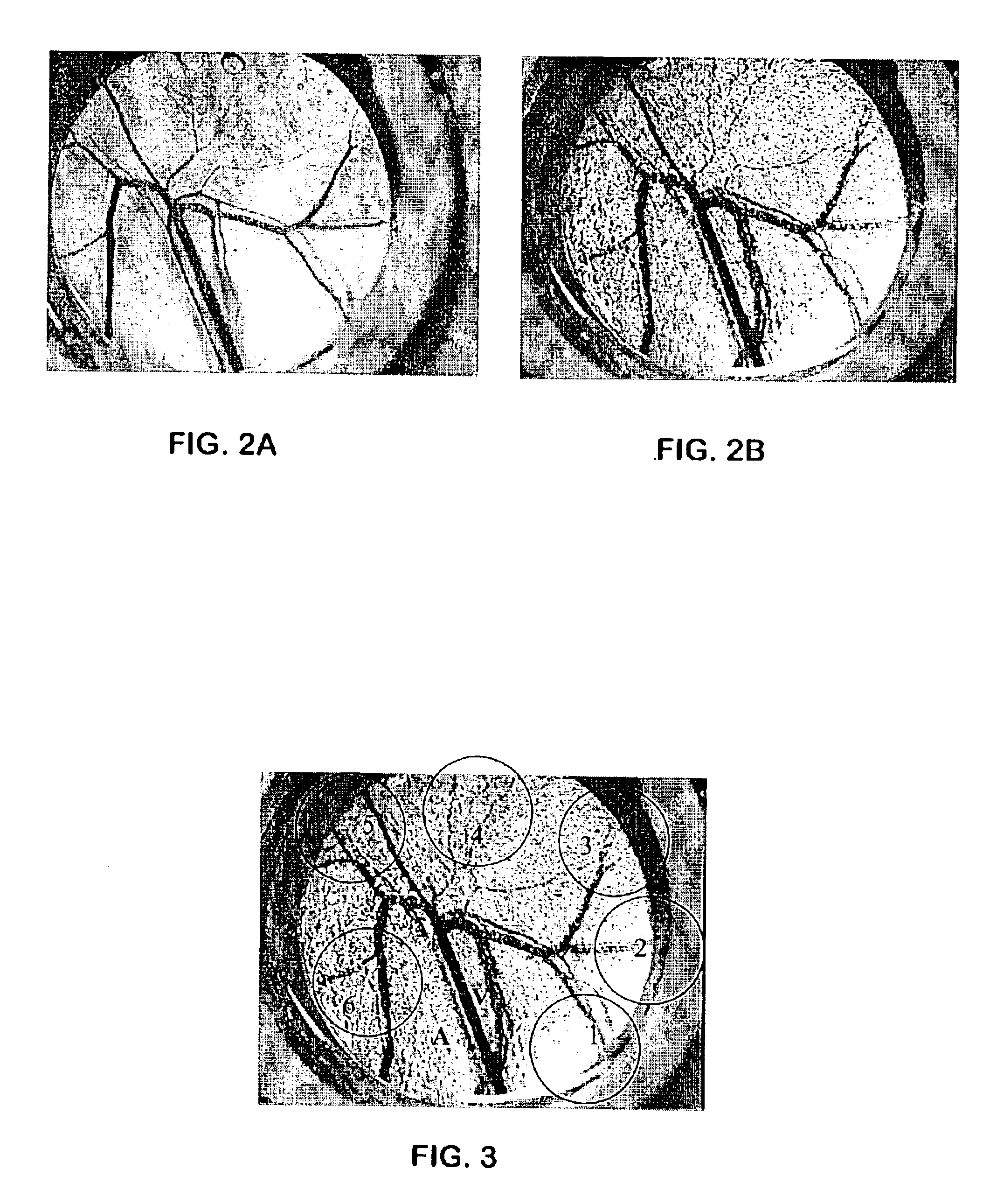 Laser treatment of cutaneous vascular lesions