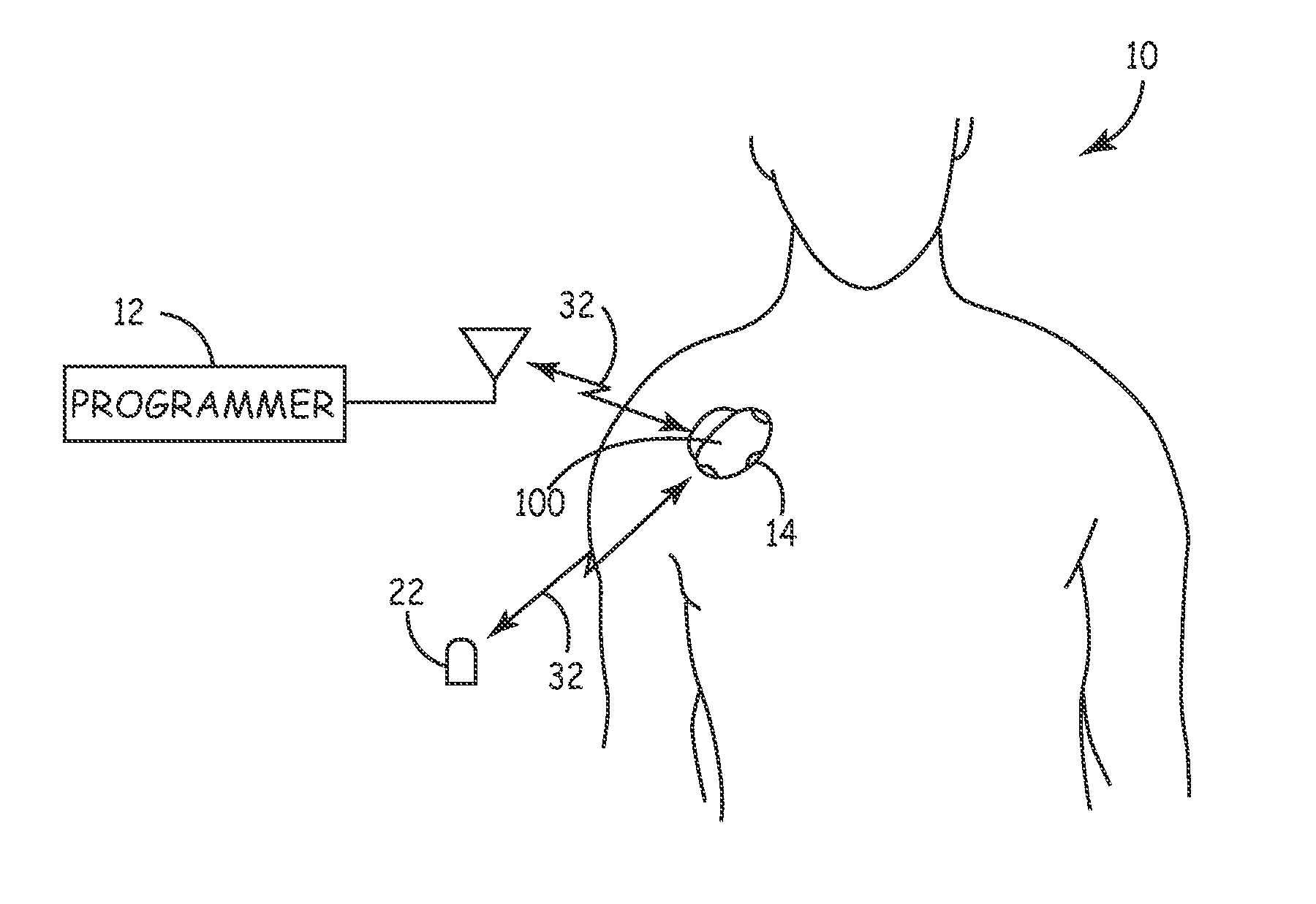 System and method for monitoring or treating nervous system disorders