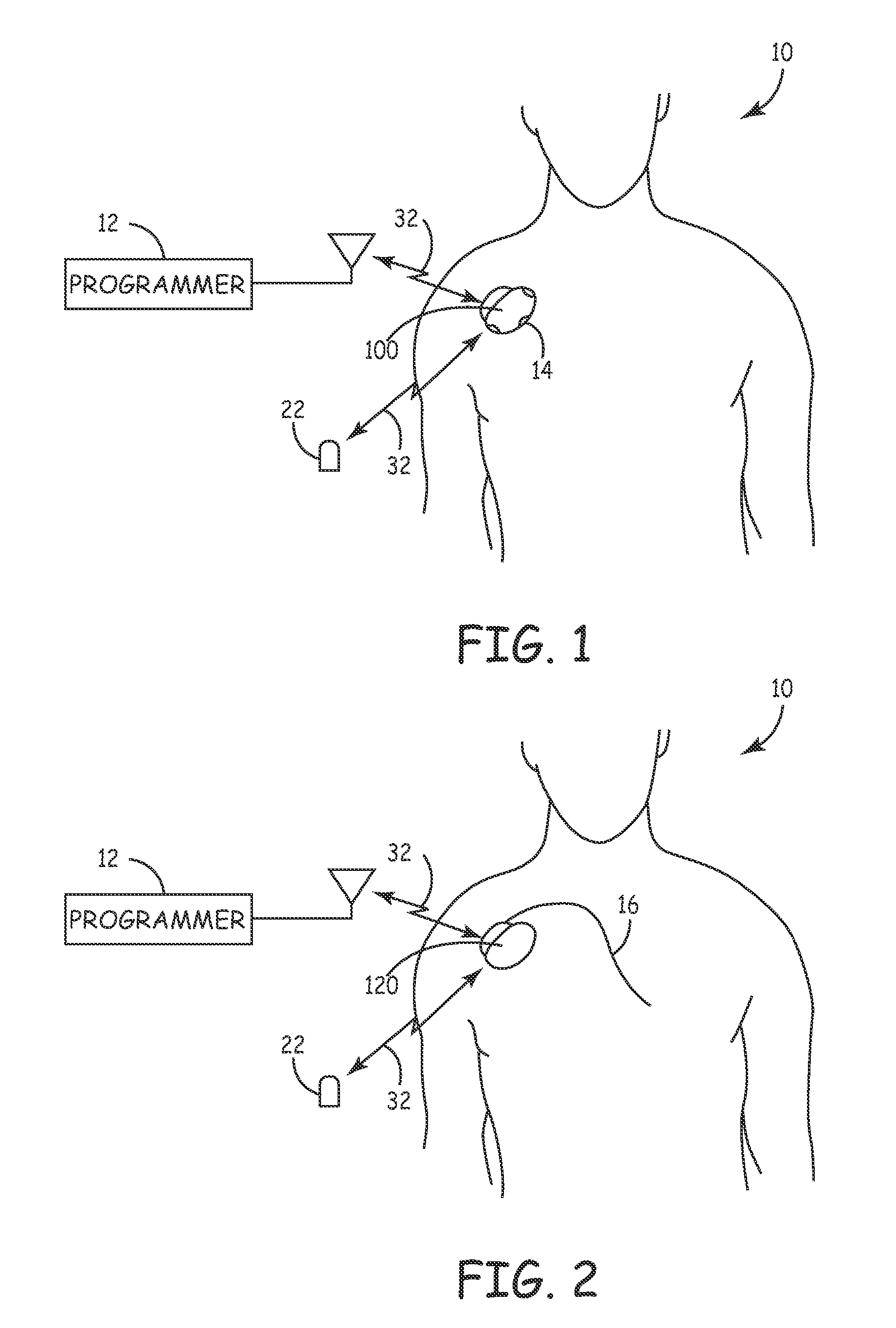 System and method for monitoring or treating nervous system disorders