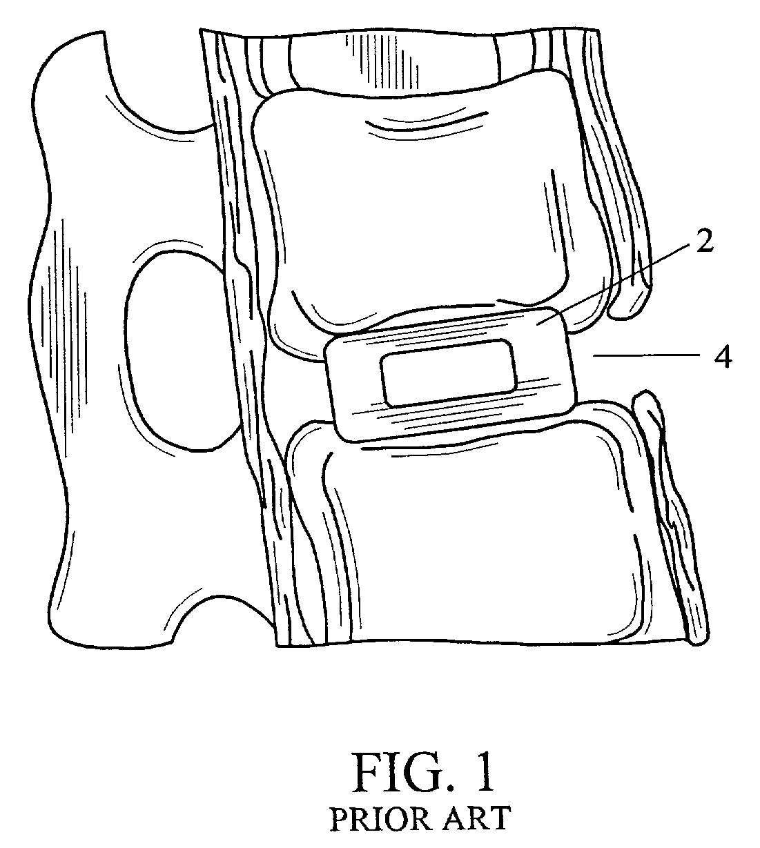 Intervertebral connection system