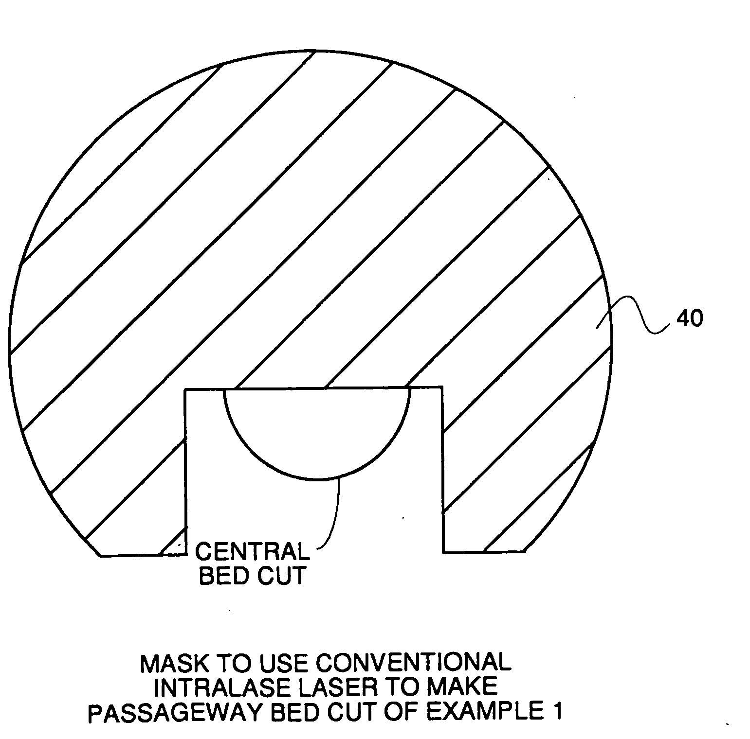 Surgical procedure and instrumentation for intrastromal implants of lens or strengthening materials