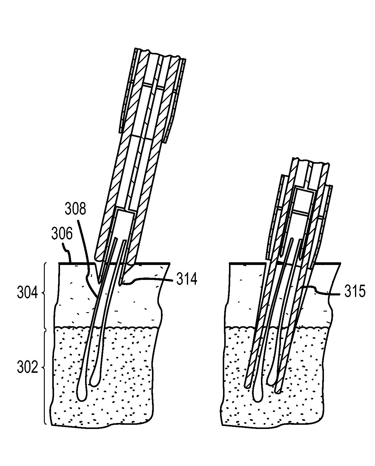 Follicular extraction method and device