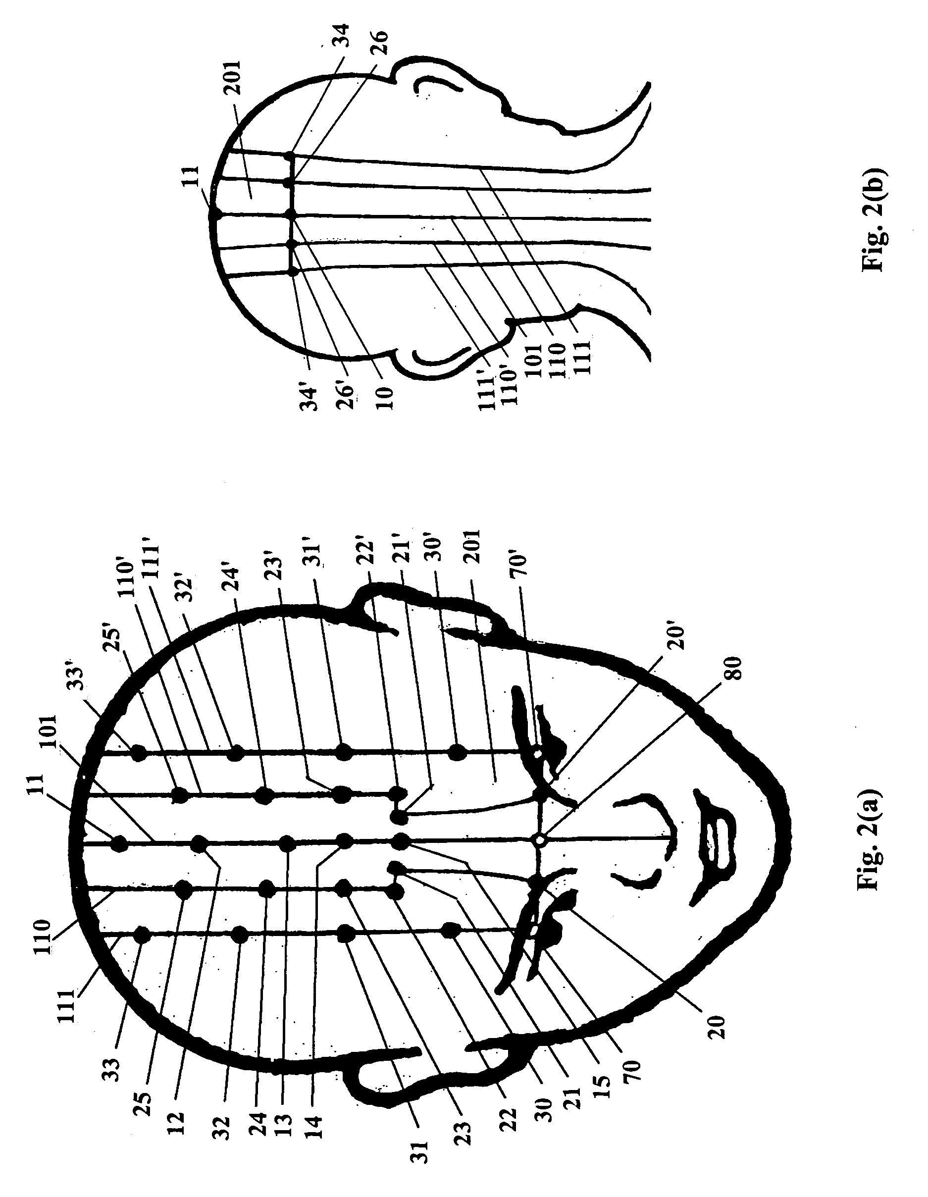 Acupressure device for treating insomnia