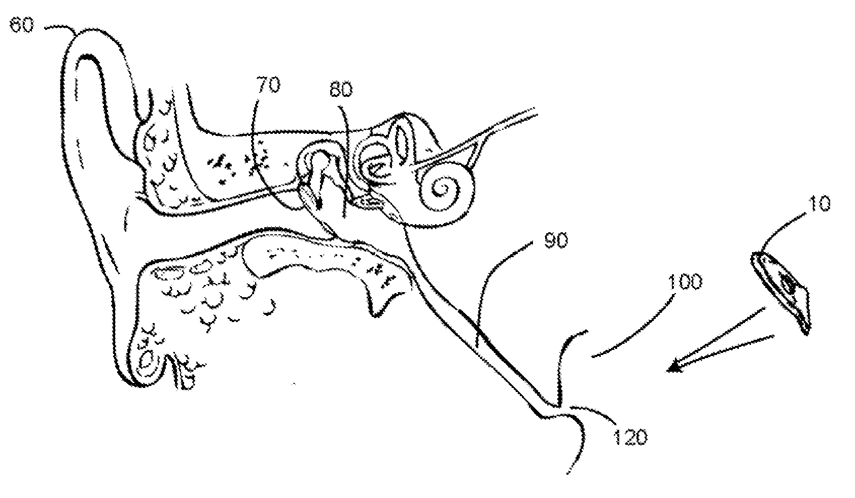 Eustachian Tube Device and Method