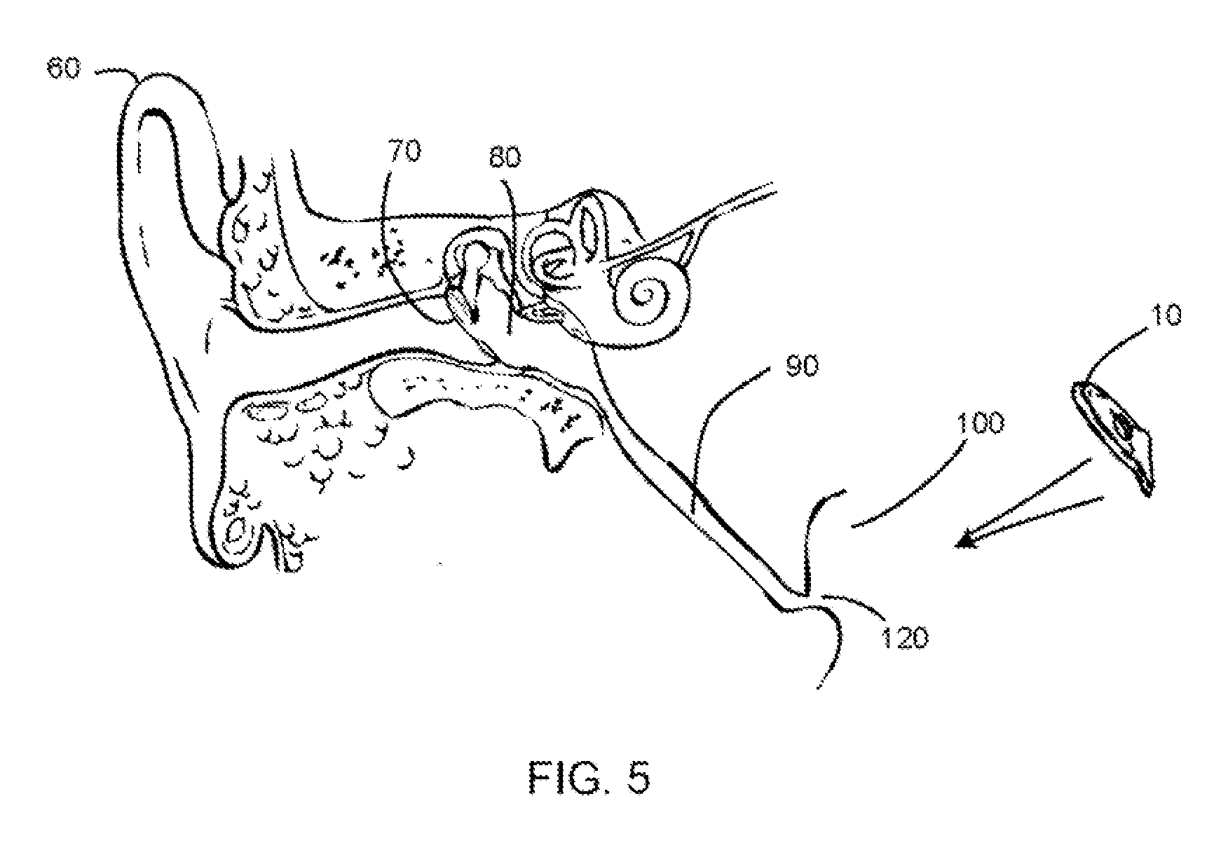 Eustachian Tube Device and Method