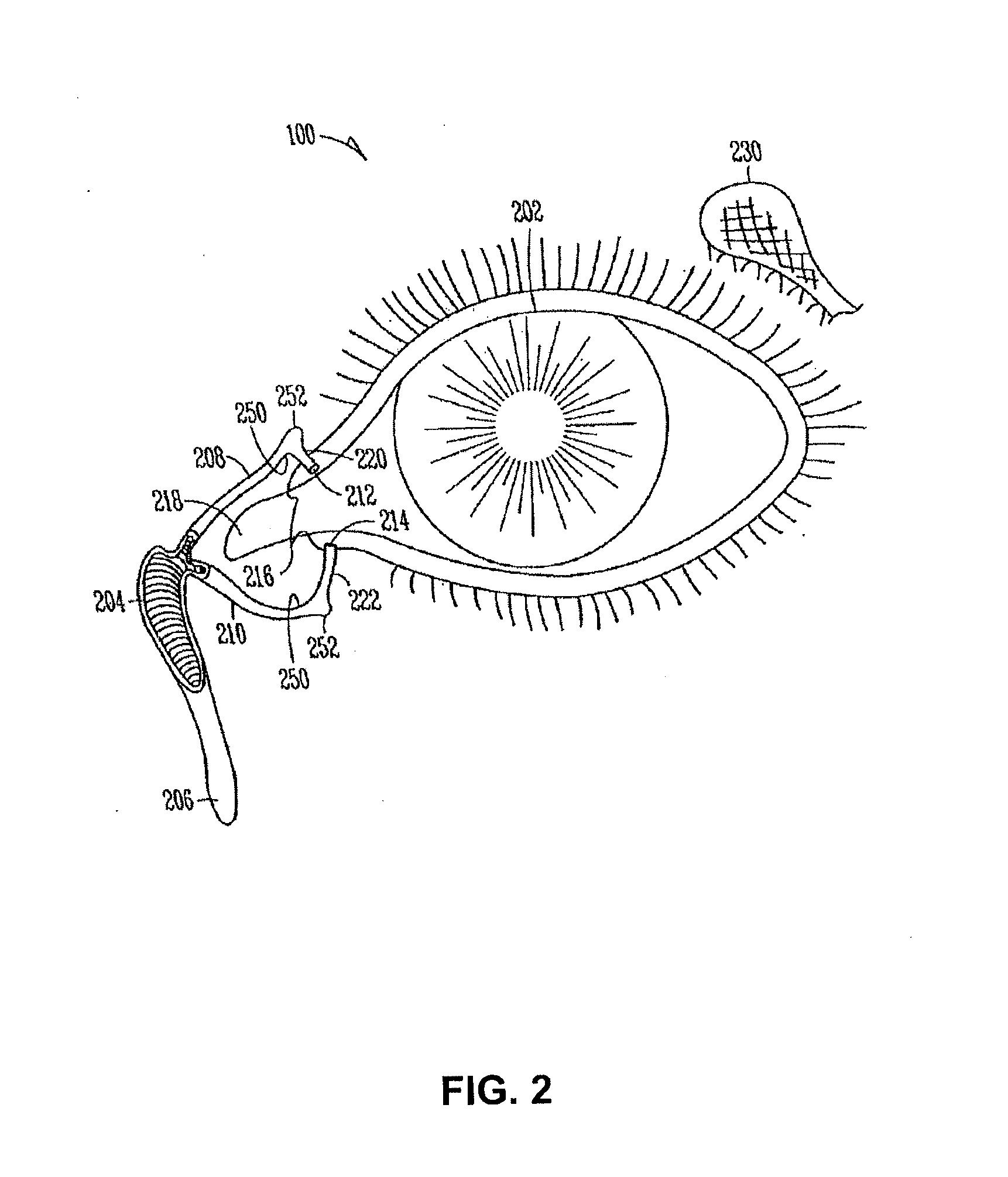 Sustained release delivery of active agents to treat glaucoma and ocular hypertension