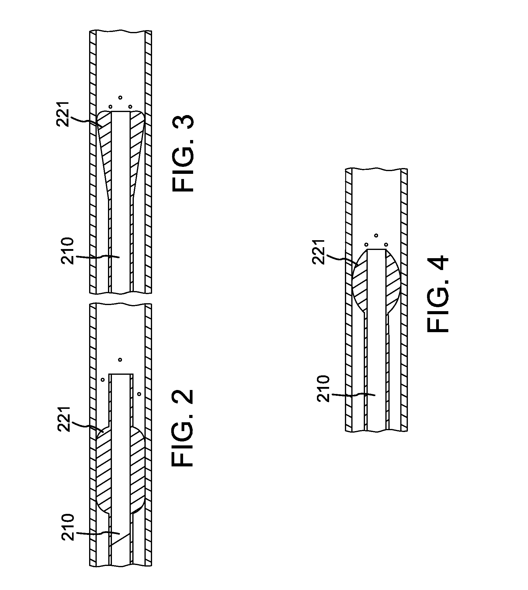 Single access flow-reversal catheter devices and methods