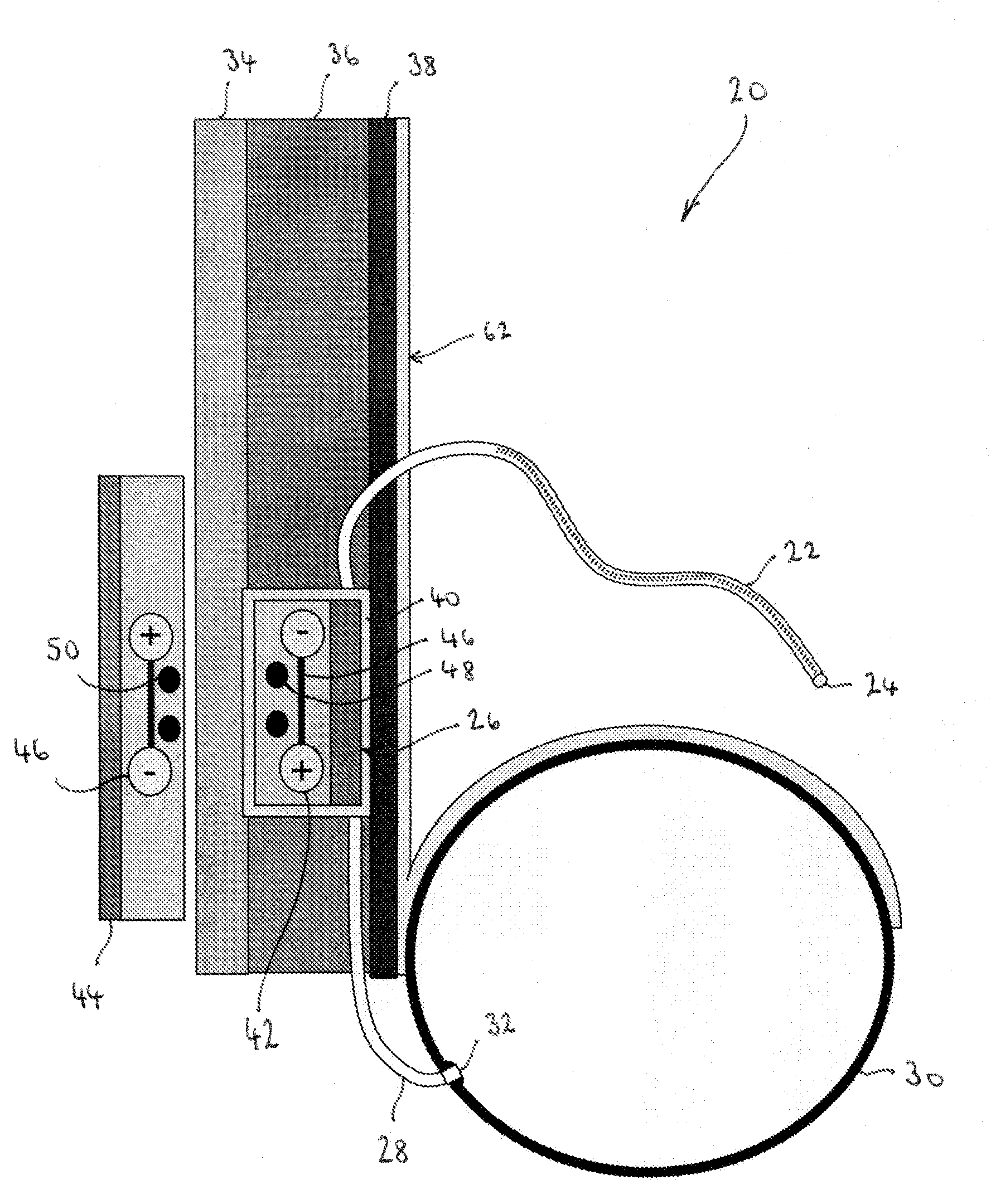 Implantable fluid management device for the removal of excess fluid