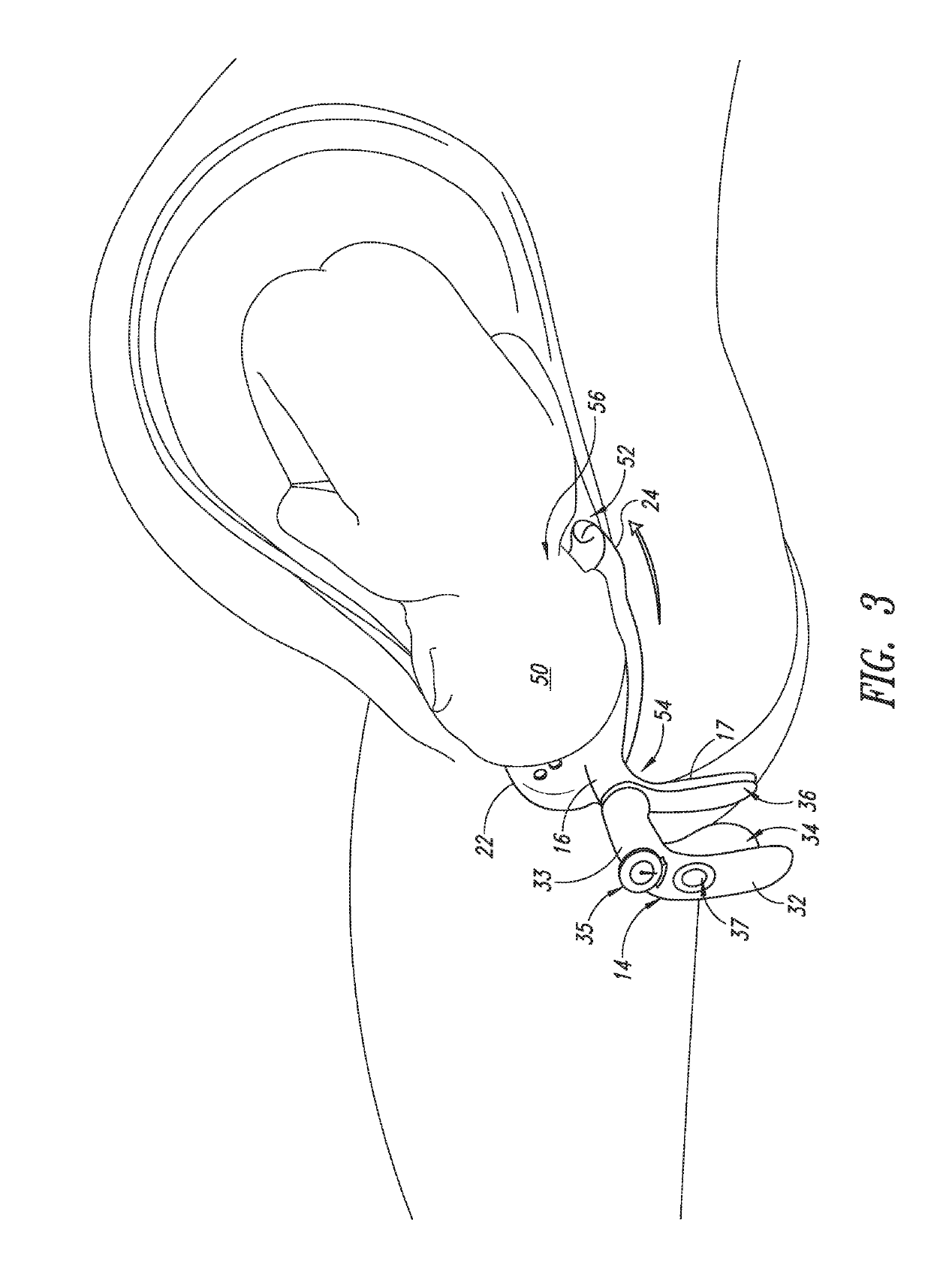 Apparatus to protect the pelvic floor during vaginal childbirth