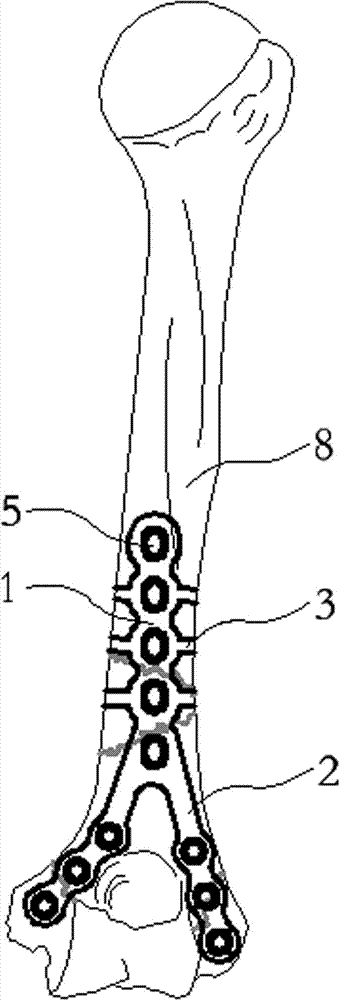 Humerus Y-type protection steel board