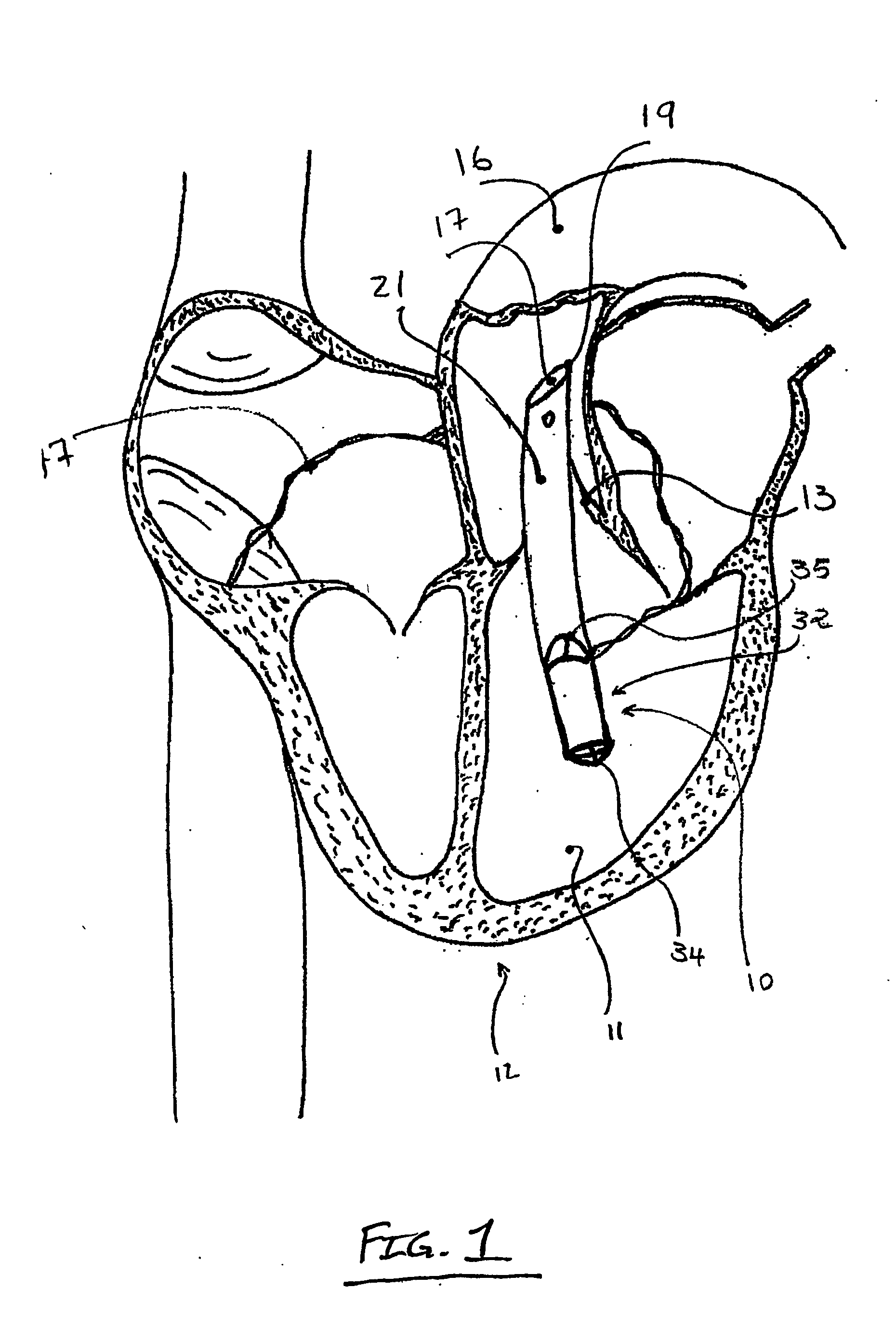 Percutaneously introduced blood pump and related methods