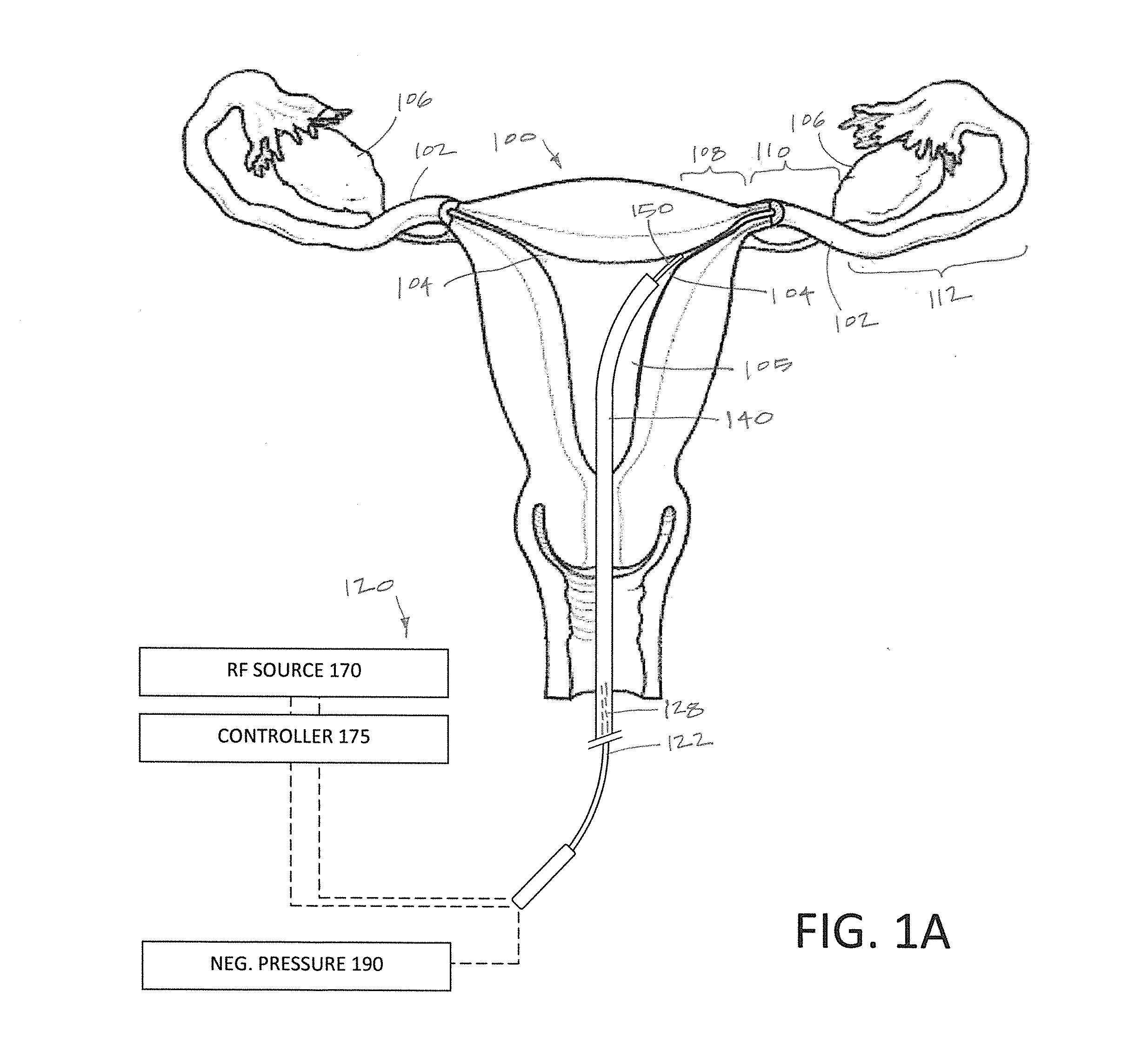 Systems and methods for permanent female contraception