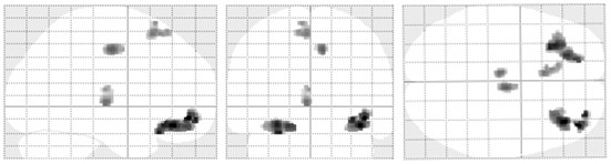 Application of KIBRA rs17070145 detection reagent in preparation of olfactory function evaluation kit