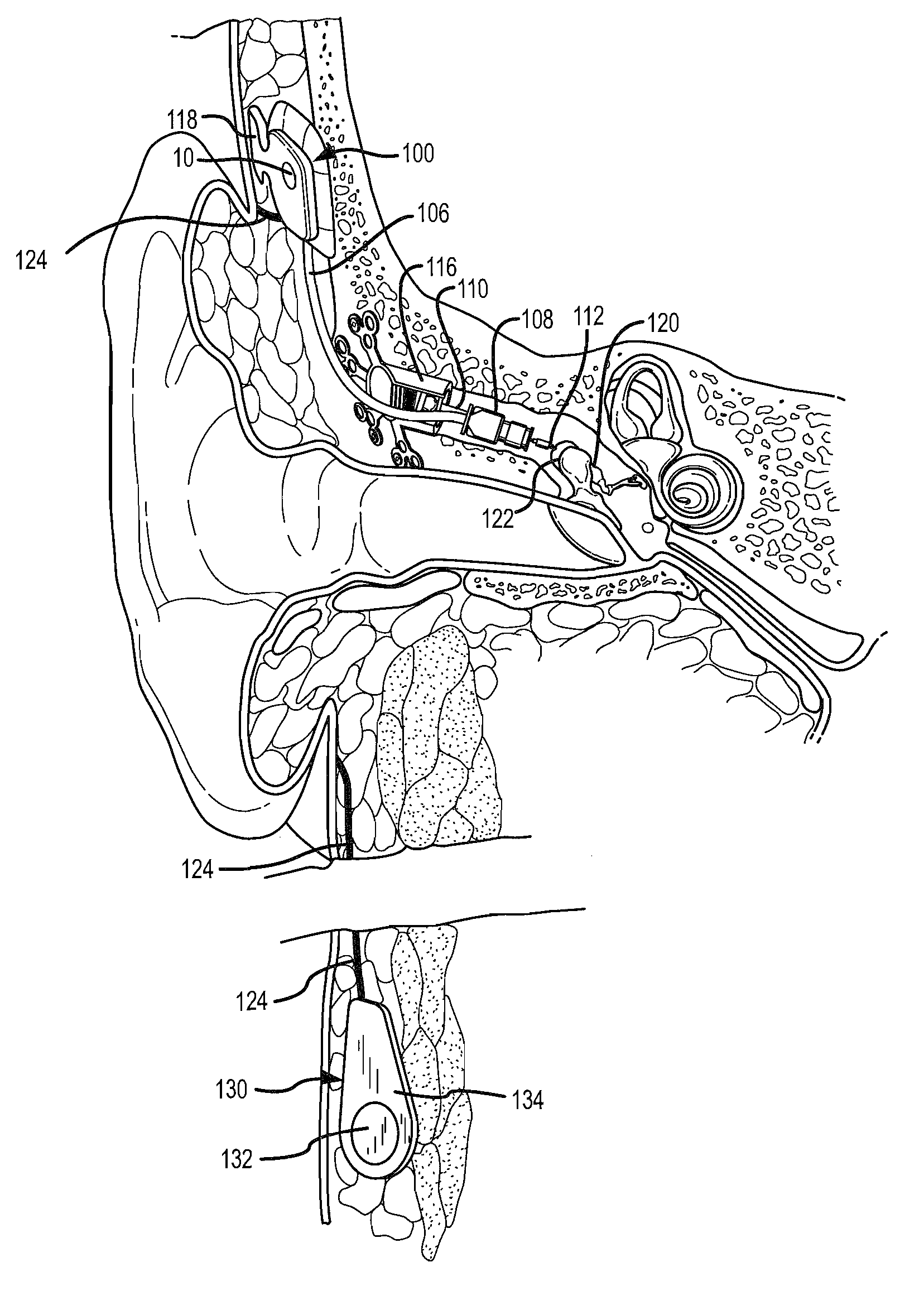 Soft tissue placement of implantable microphone