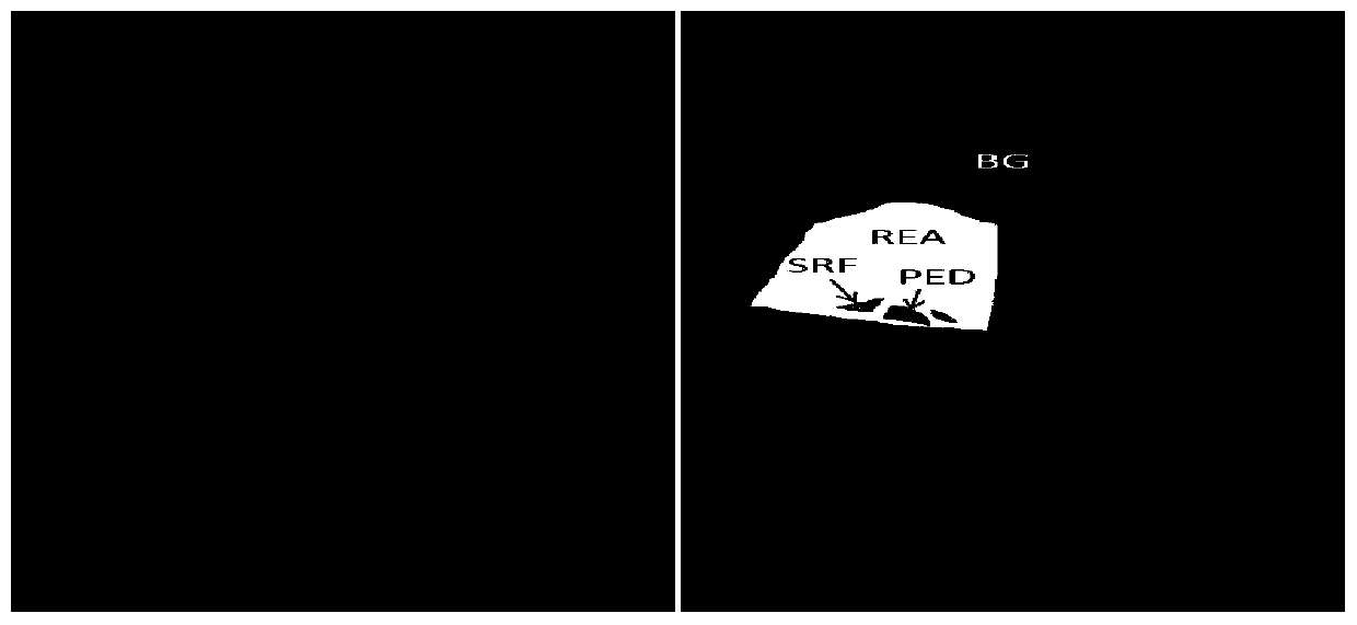 Retinal macular edema multi-lesion image segmentation method