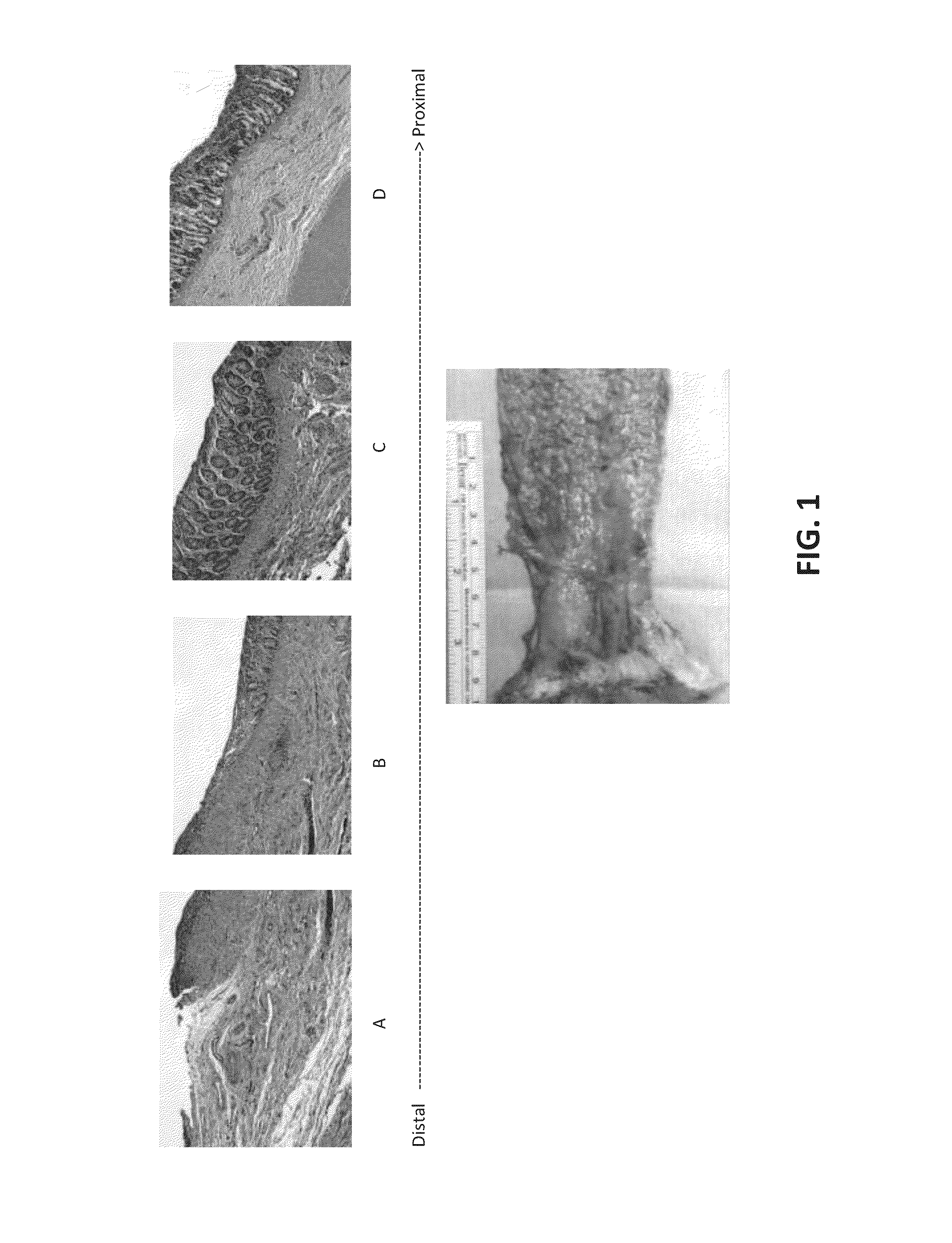 Method and composition for treating inflammatory bowel disease without colectomy