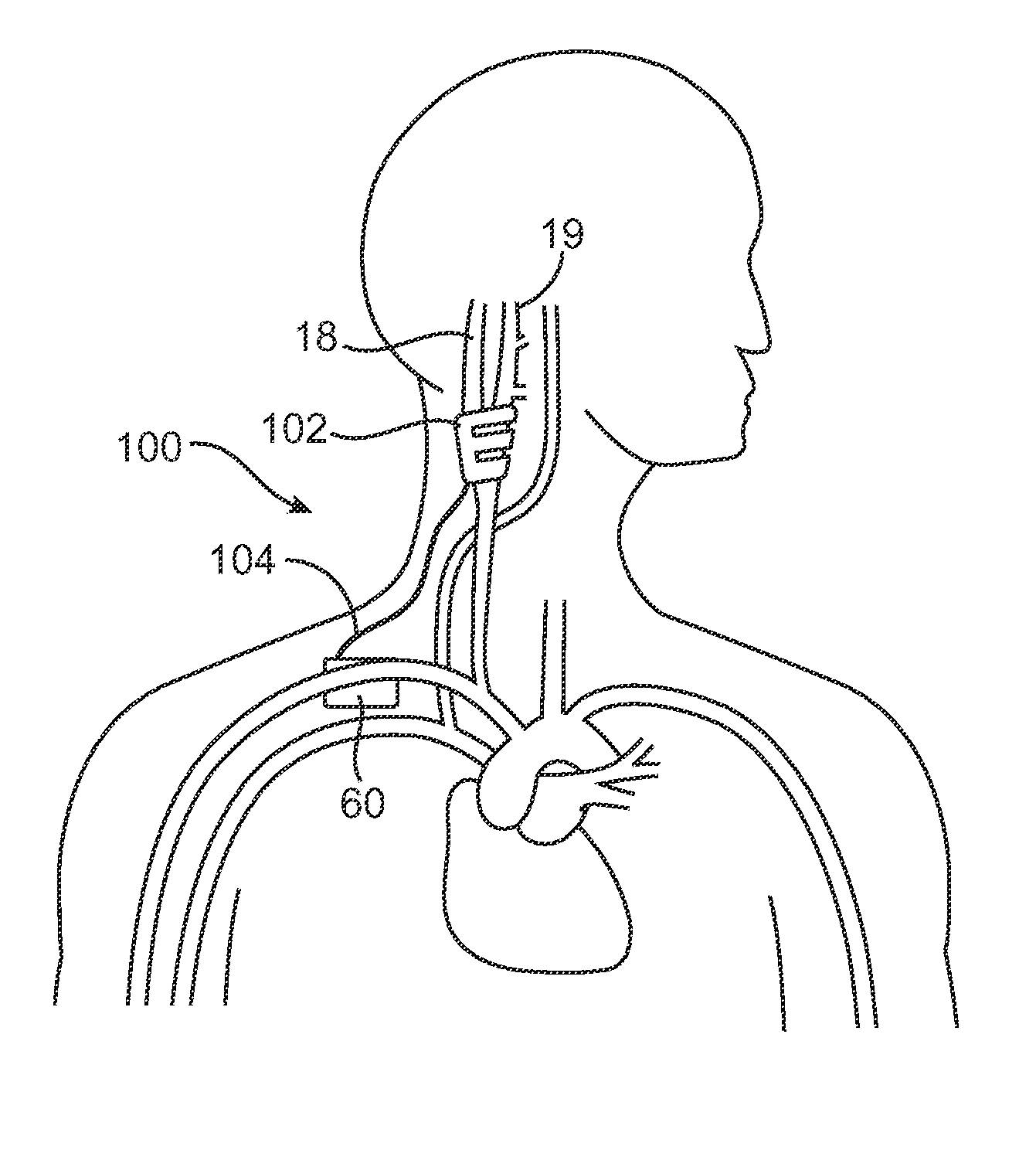 Treatment of peripheral vascular disease by baroreflex activation