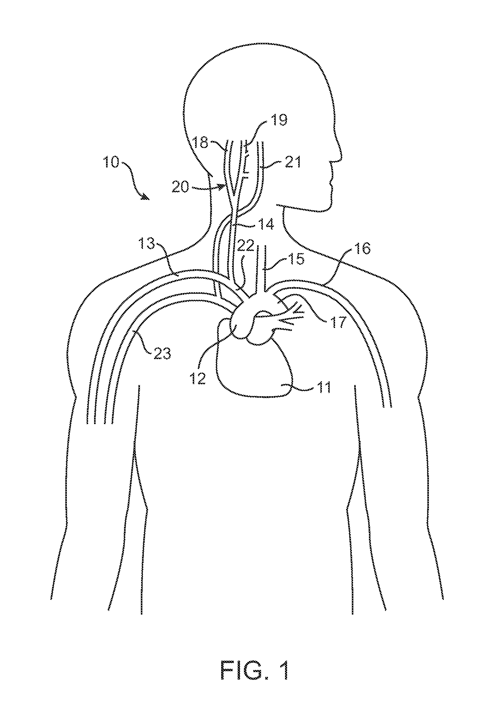 Treatment of peripheral vascular disease by baroreflex activation