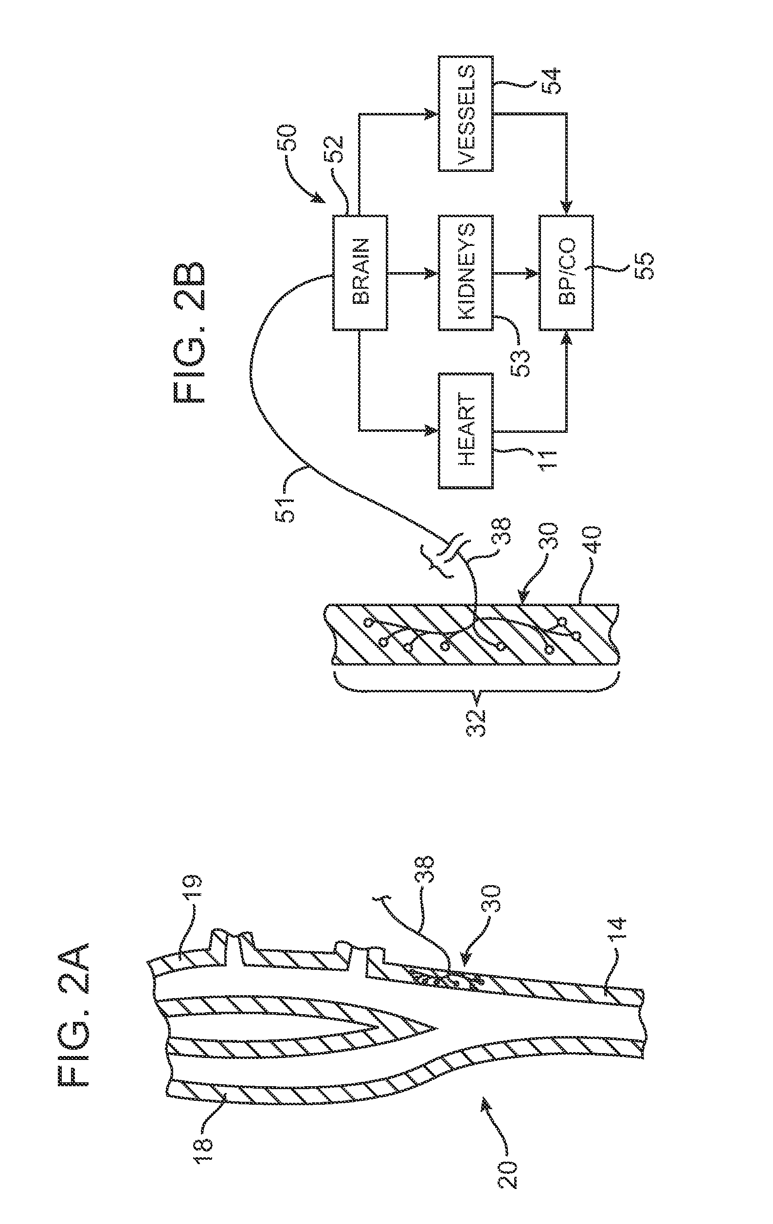 Treatment of peripheral vascular disease by baroreflex activation