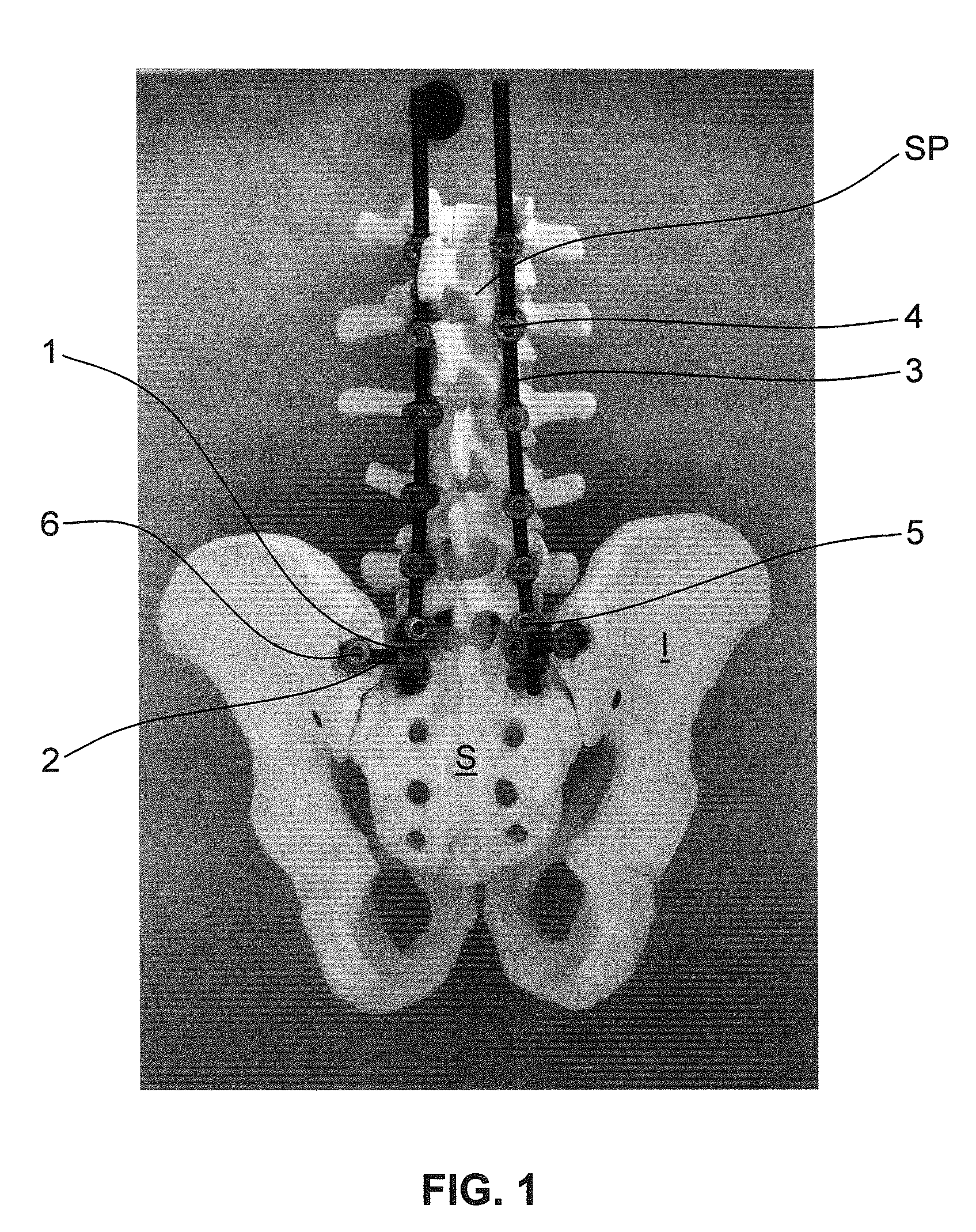 Iliac connector, connector head, spinal fixation system and method of stabilizing a spine