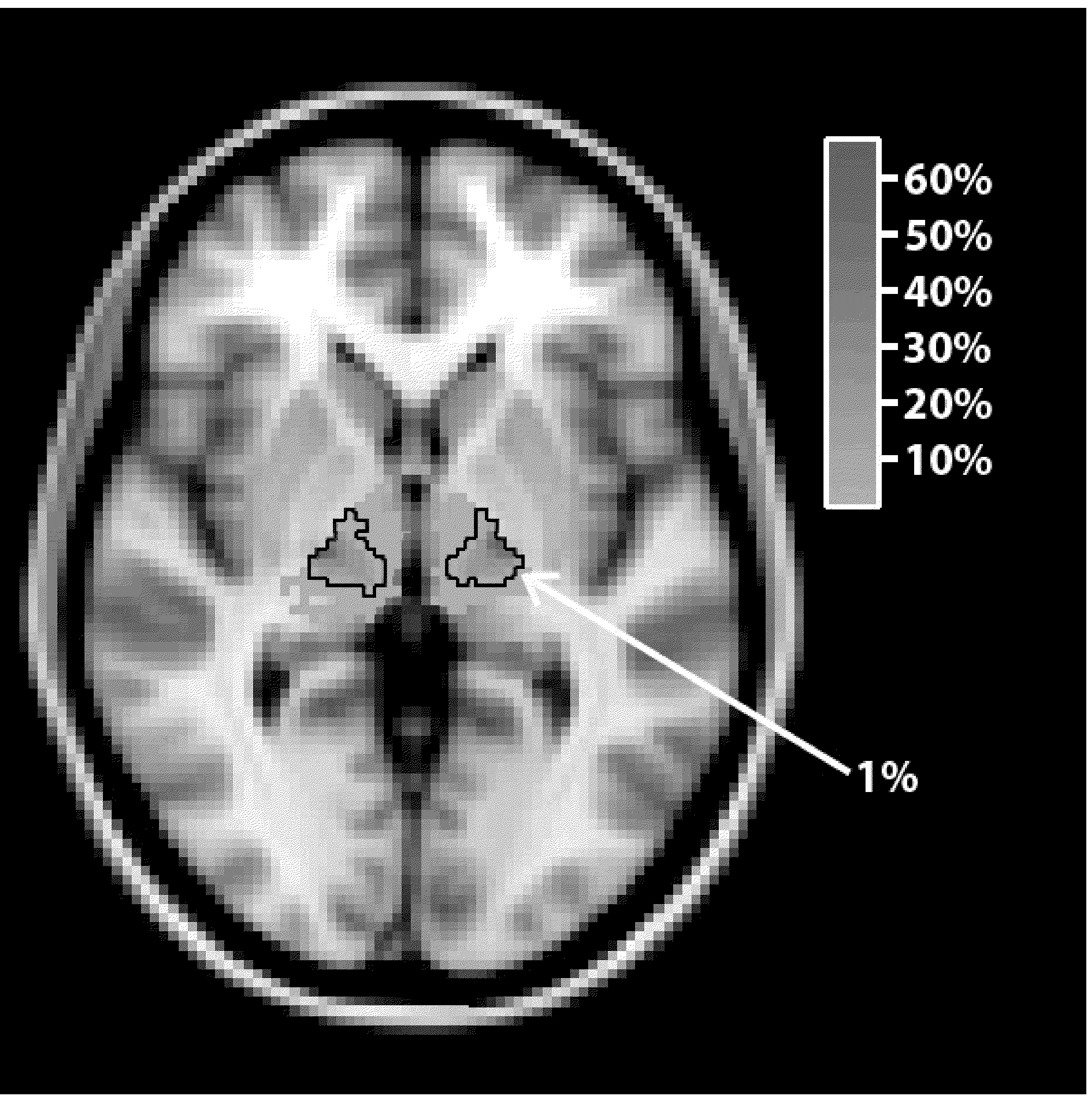 Method for deep brain stimulation targeting based on brain connectivity