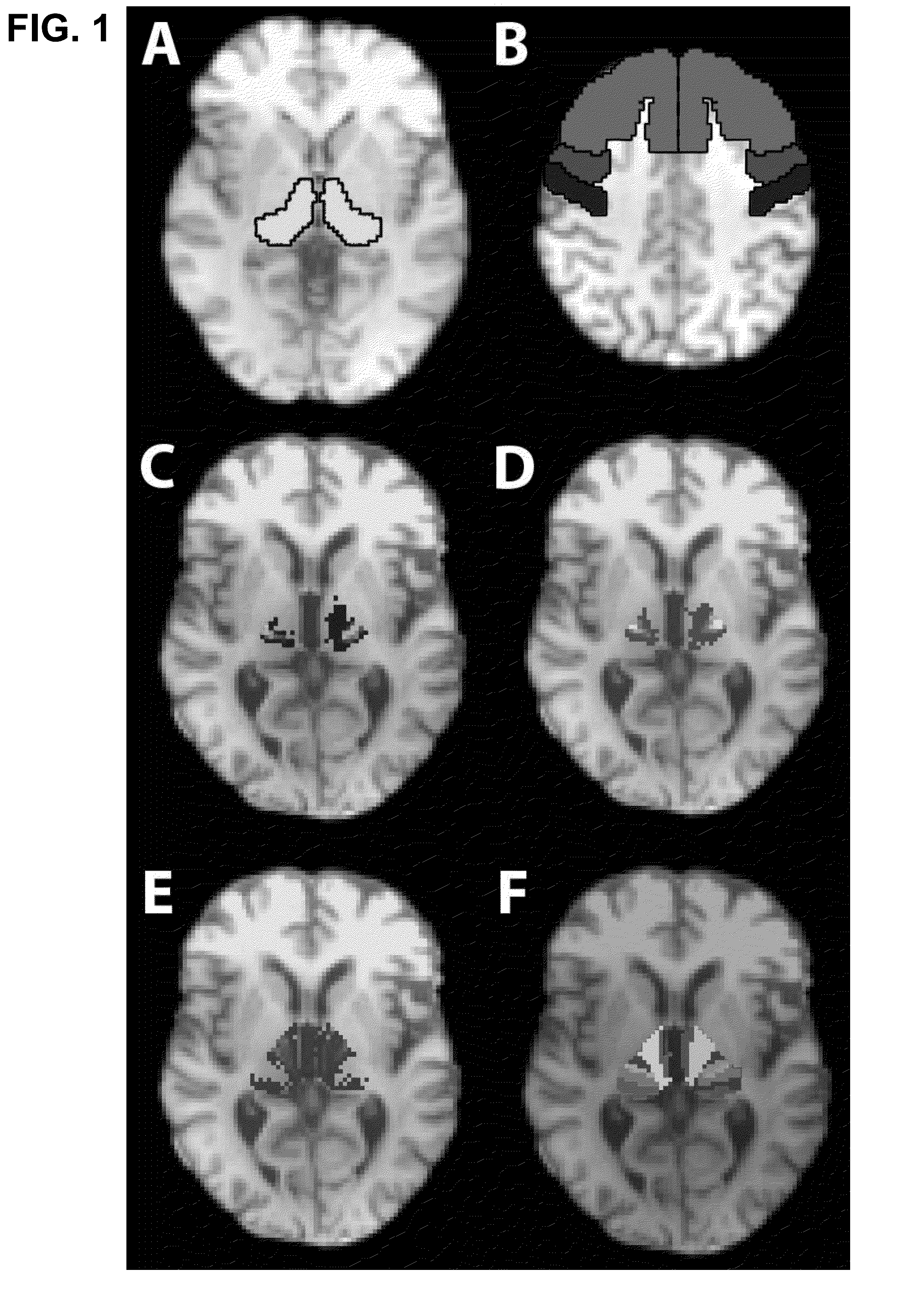 Method for deep brain stimulation targeting based on brain connectivity