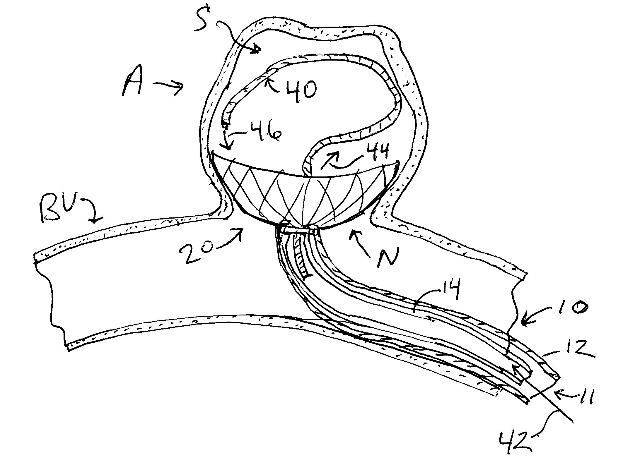 Aneurysm occlusion device