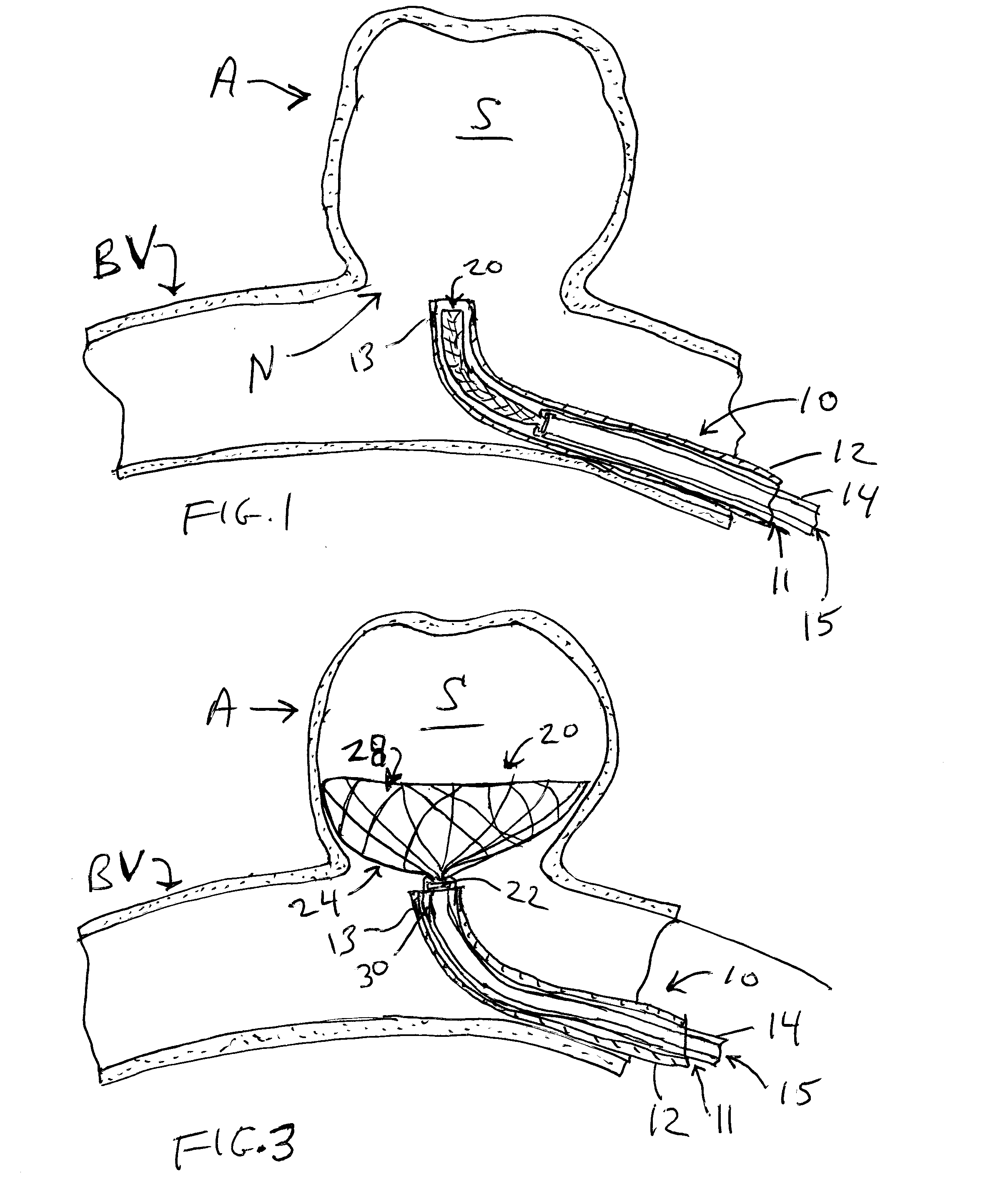 Aneurysm occlusion device