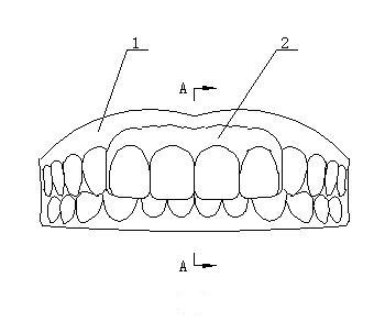 Mouth breathing corrector and preparation method thereof