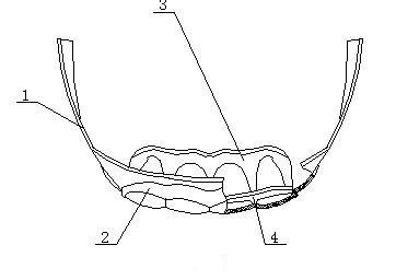 Mouth breathing corrector and preparation method thereof