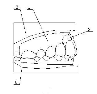 Mouth breathing corrector and preparation method thereof