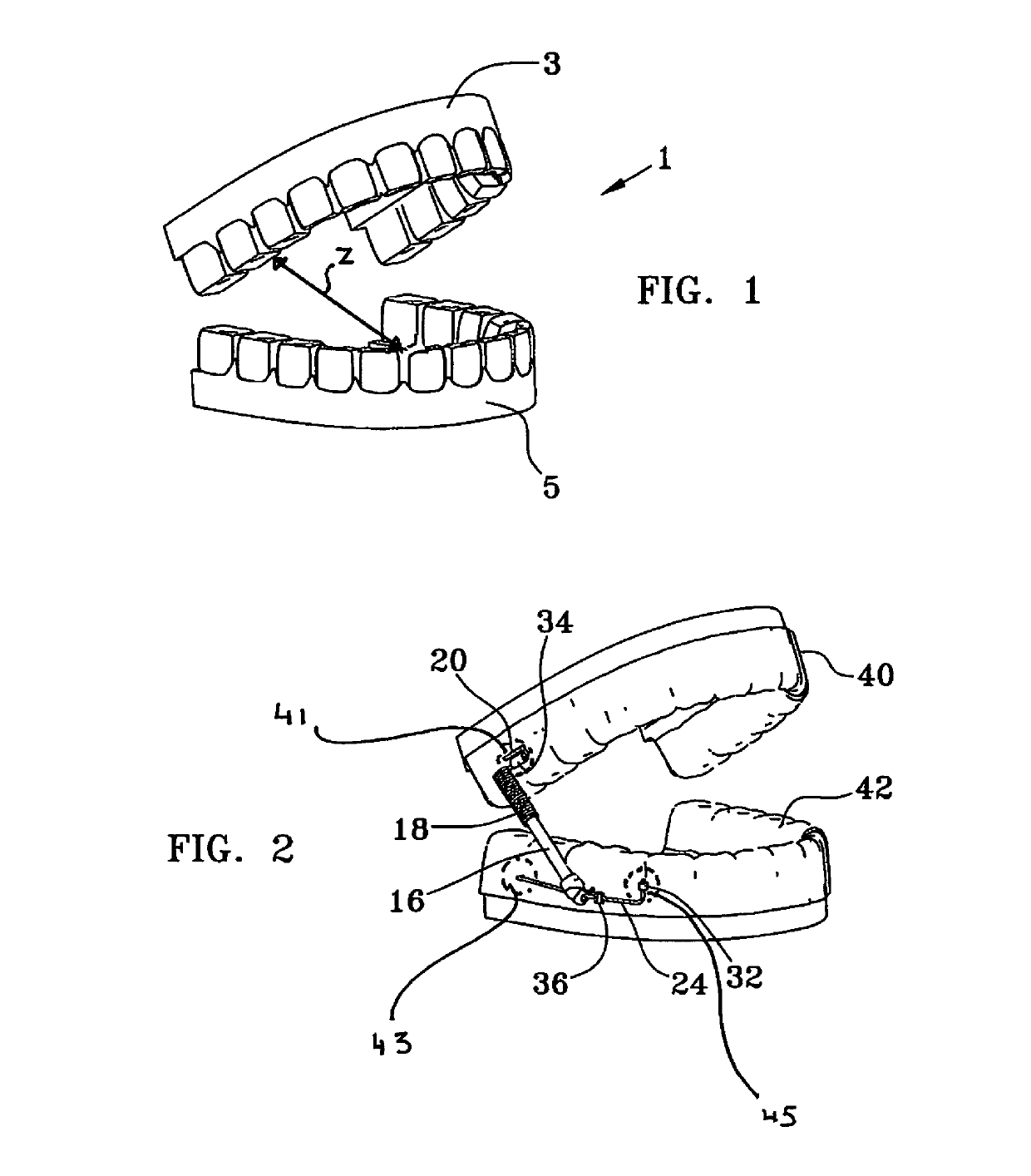 Method and apparatus for orthodontic corrections