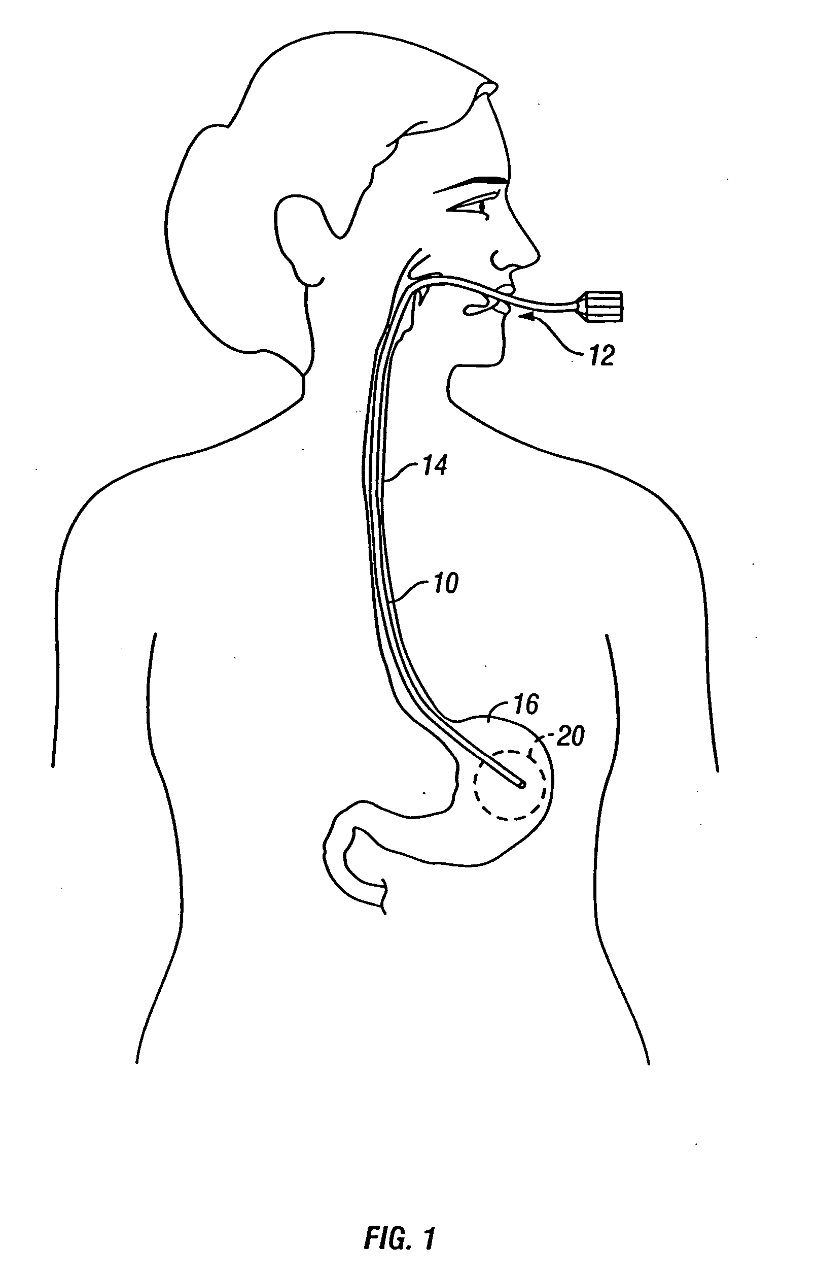 Intra-gastric fastening devices