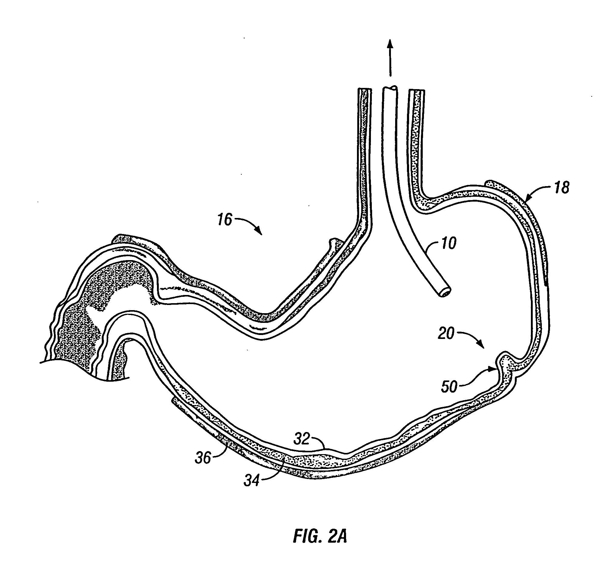 Intra-gastric fastening devices