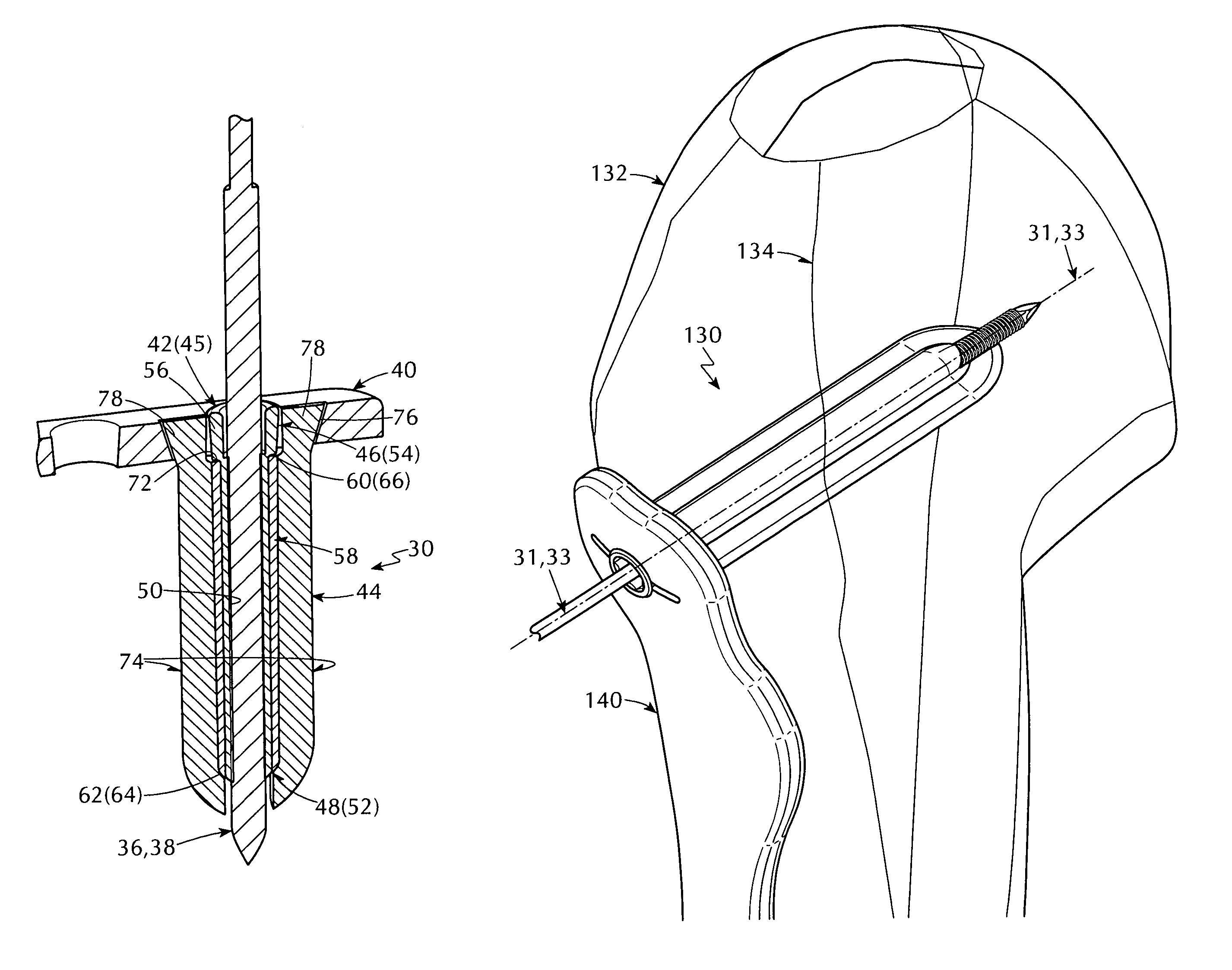 Interchangeable orthopedic blade