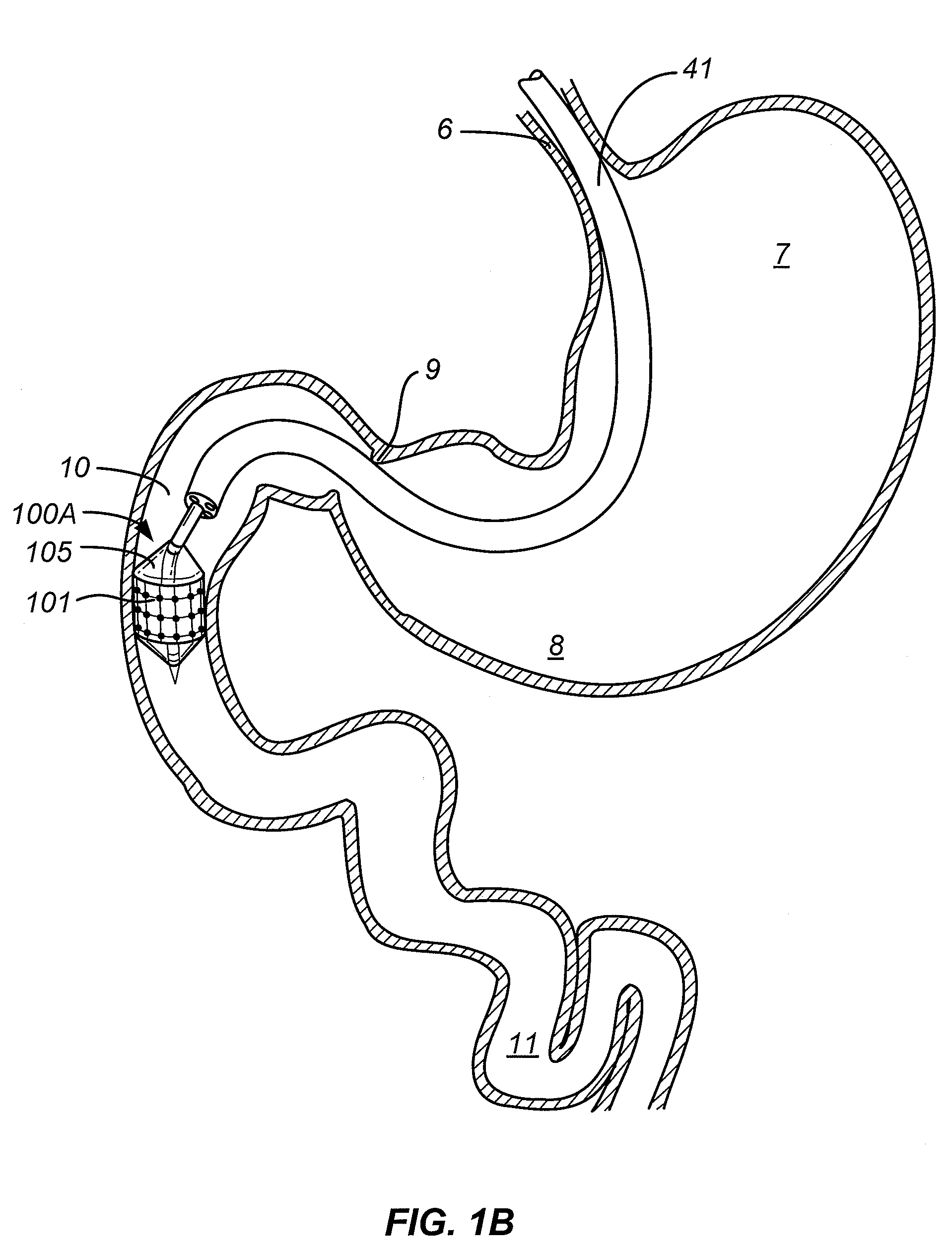 Method and apparatus for gastrointestinal tract ablation for treatment of obesity