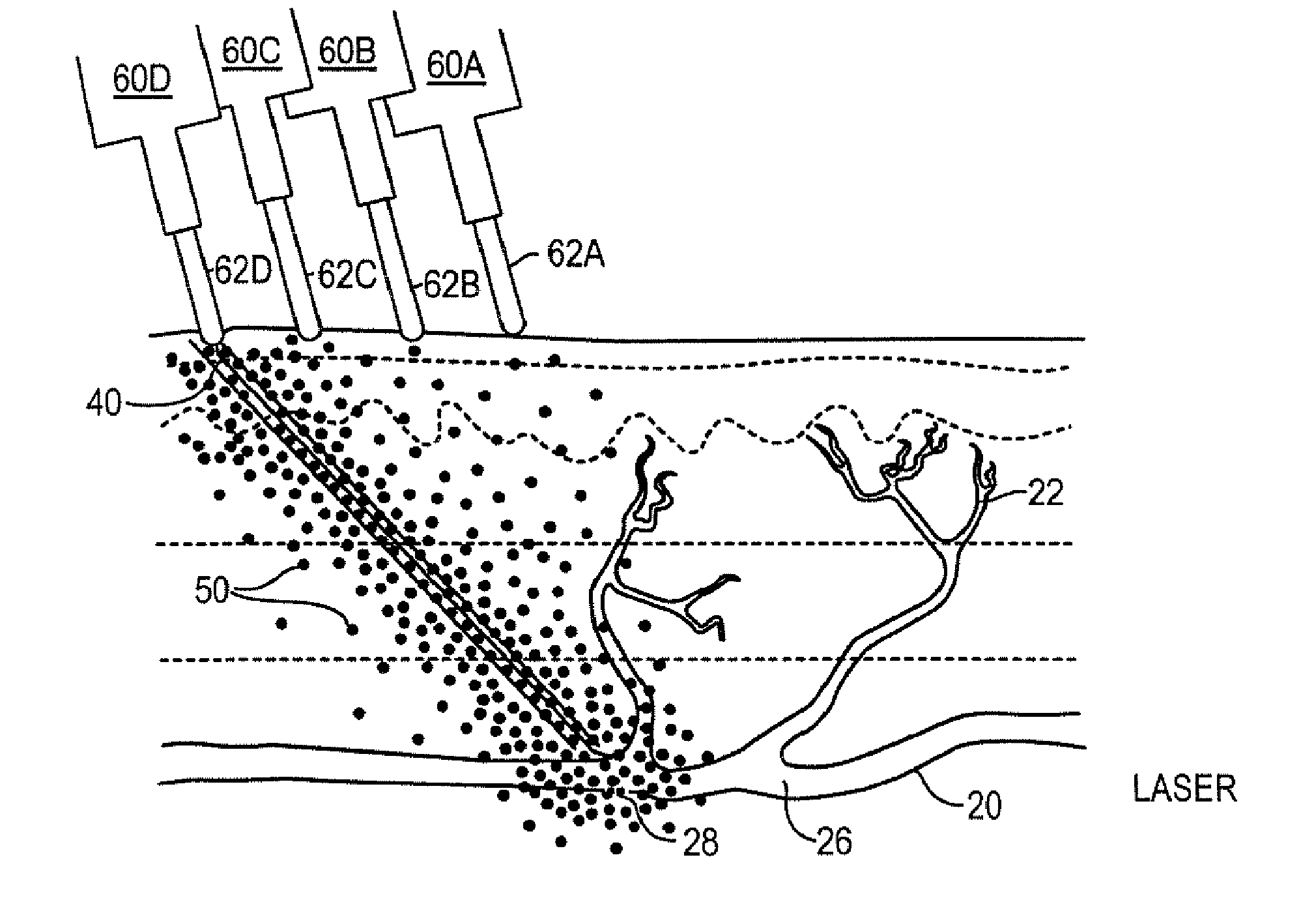Method and kit for treatment of varicose veins and other superficial venous pathology