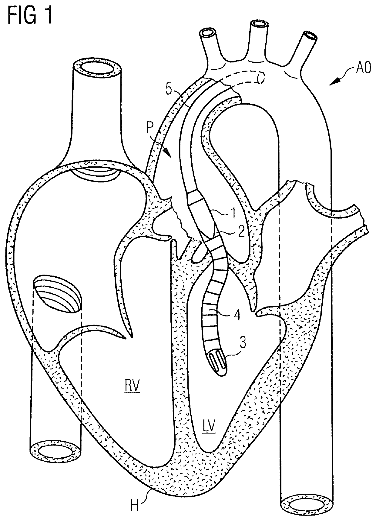 Method of manufacturing a blood pump