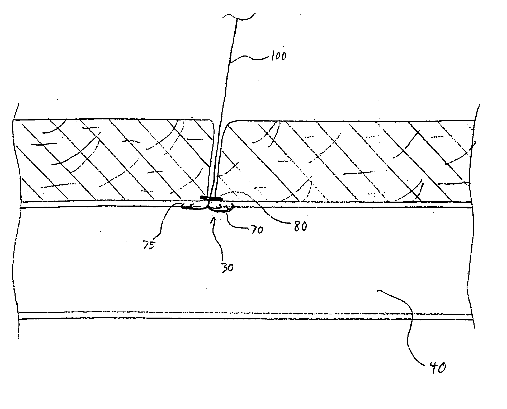 Vascular closure device