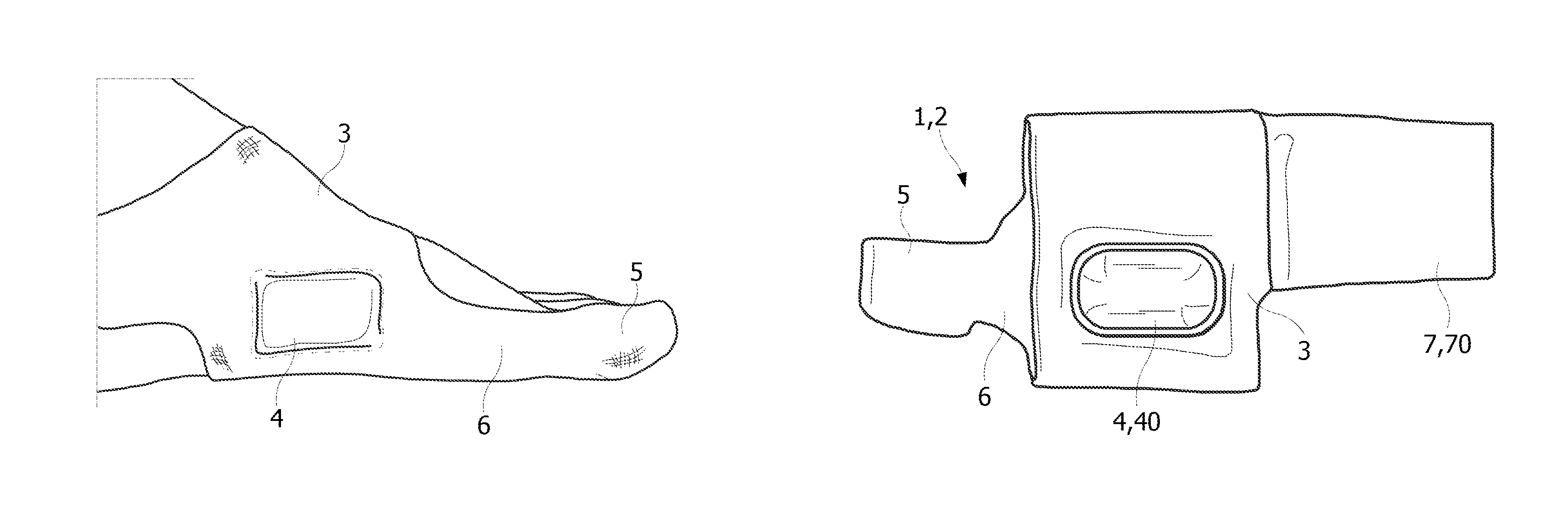 Orthopedic device for mechanical treatment of hallux valgus