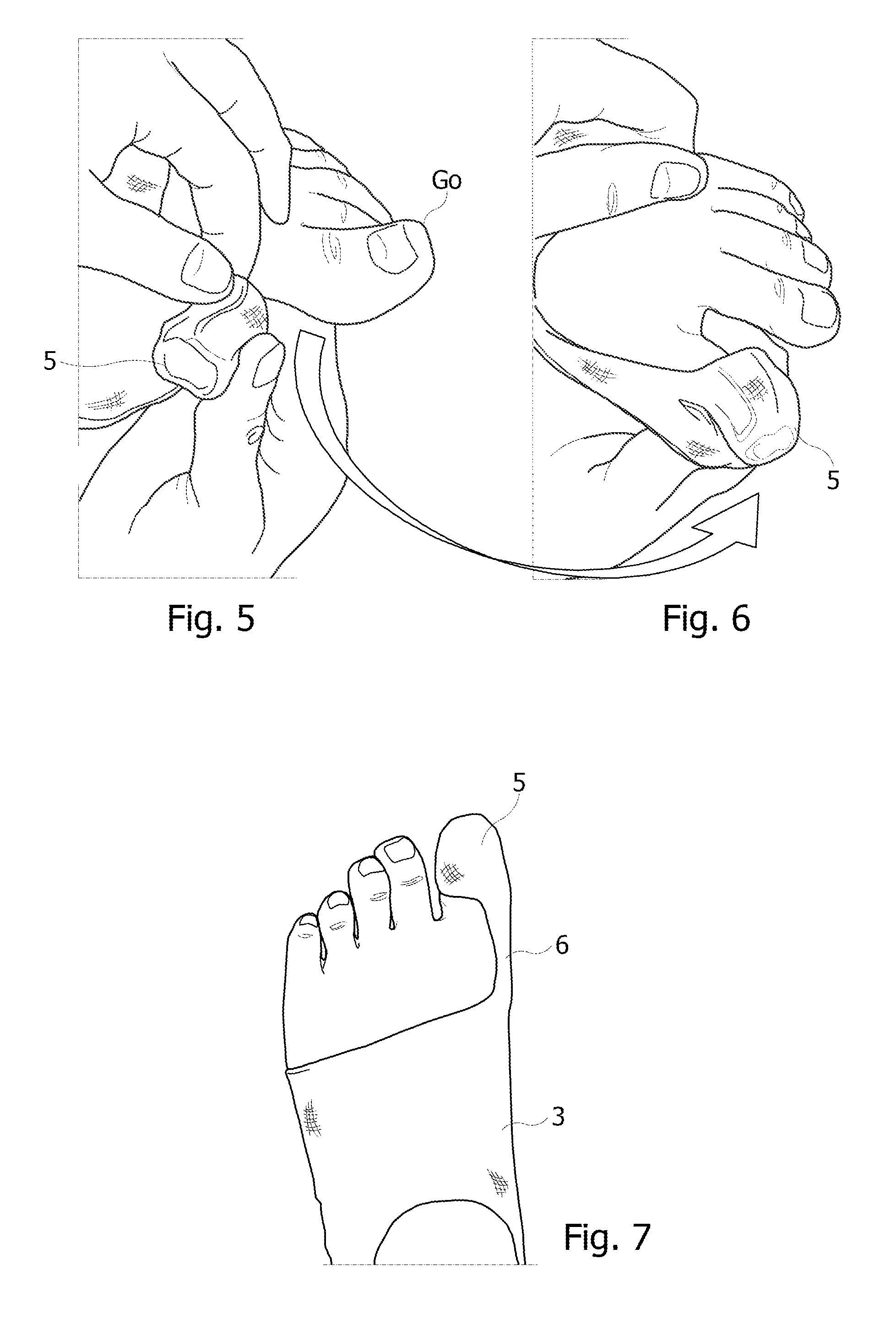 Orthopedic device for mechanical treatment of hallux valgus