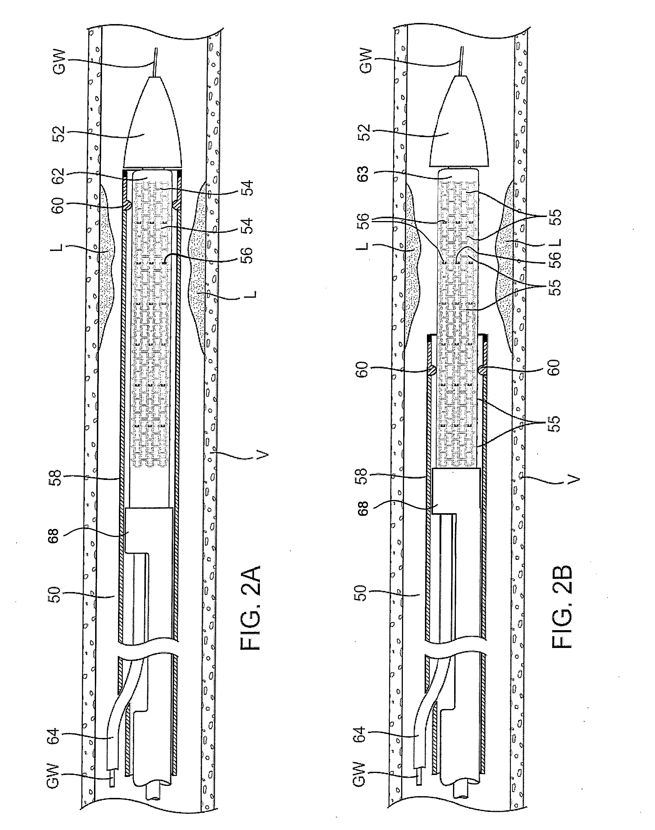 Apparatus and methods for interlocking stent segments