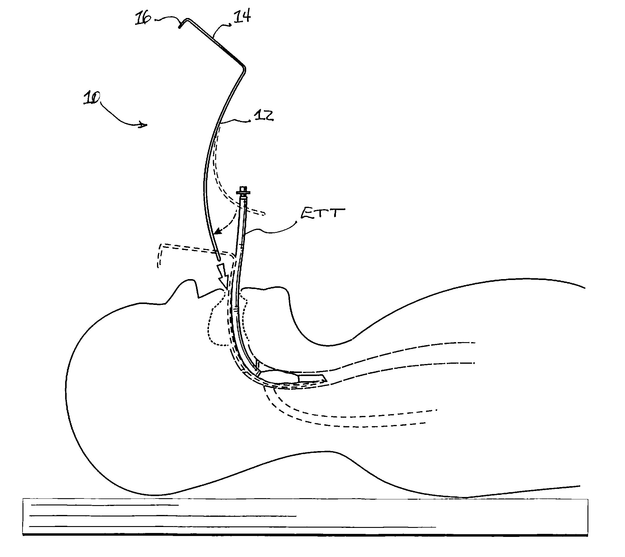 Endotracheal Tube Exchanger