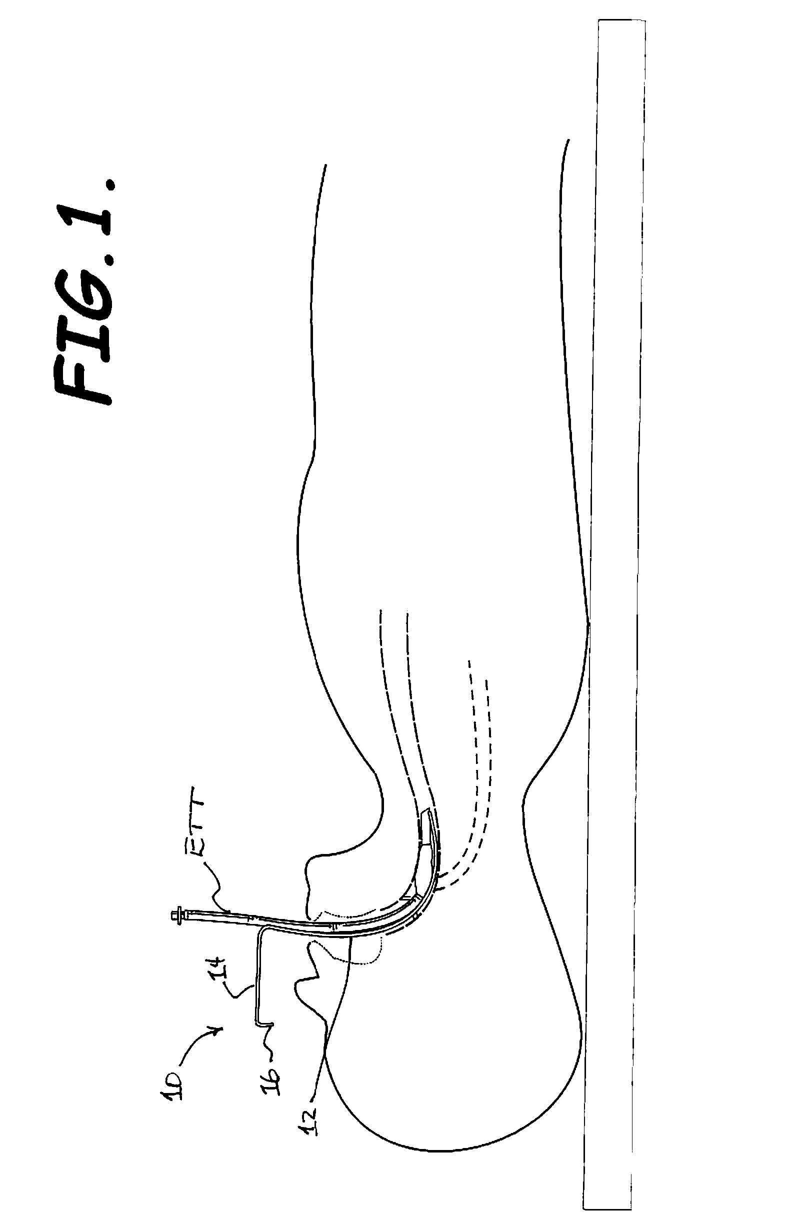 Endotracheal Tube Exchanger