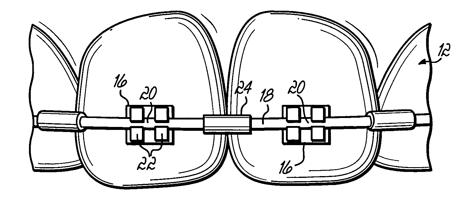 Archwire assembly with stops