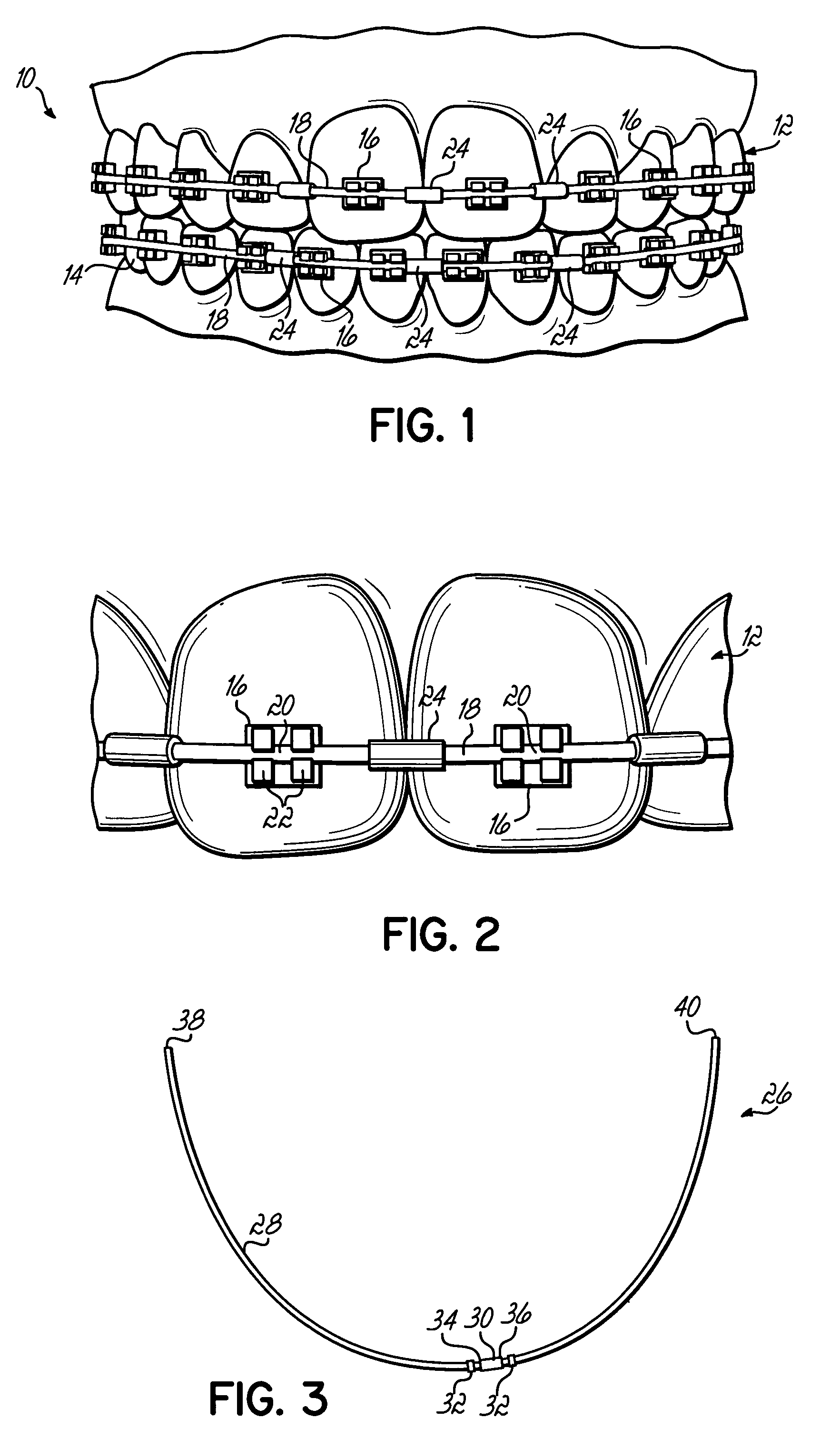 Archwire assembly with stops